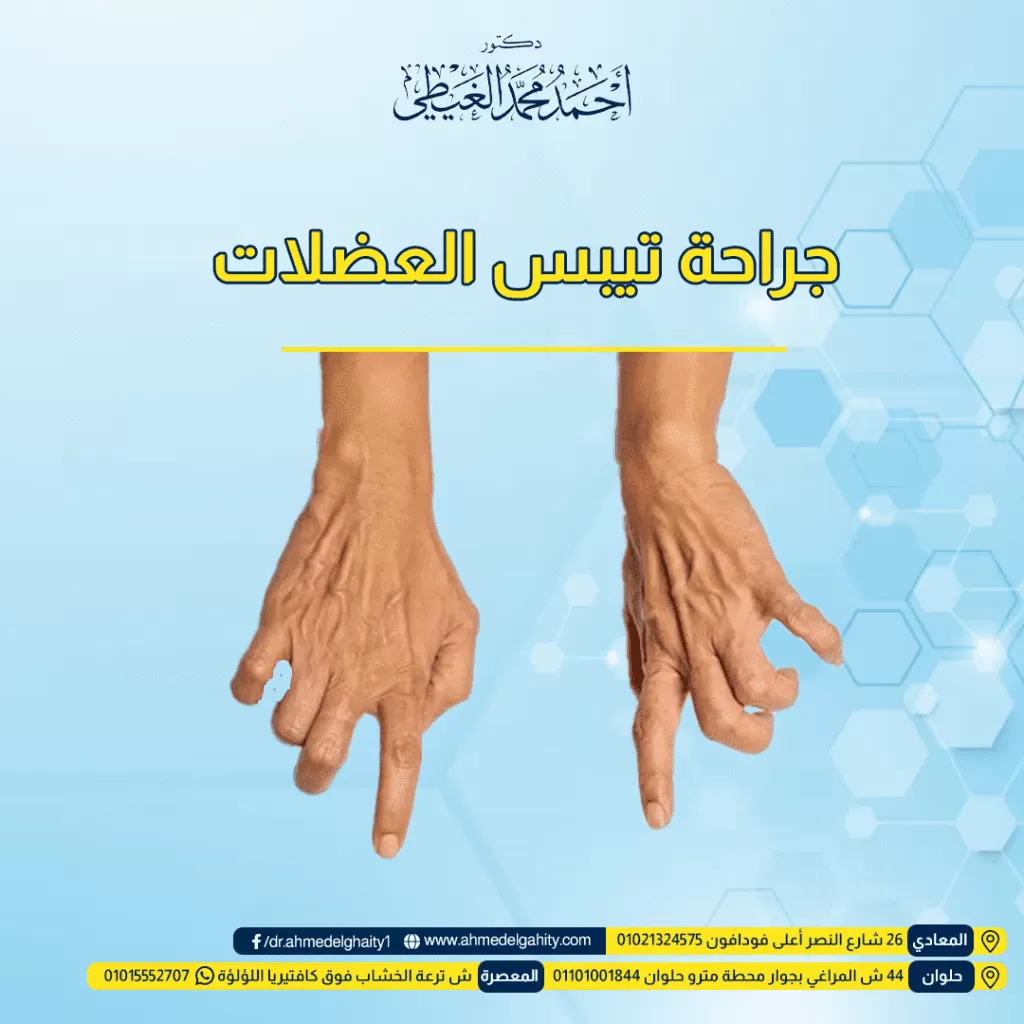 جراحة تيبس العضلات