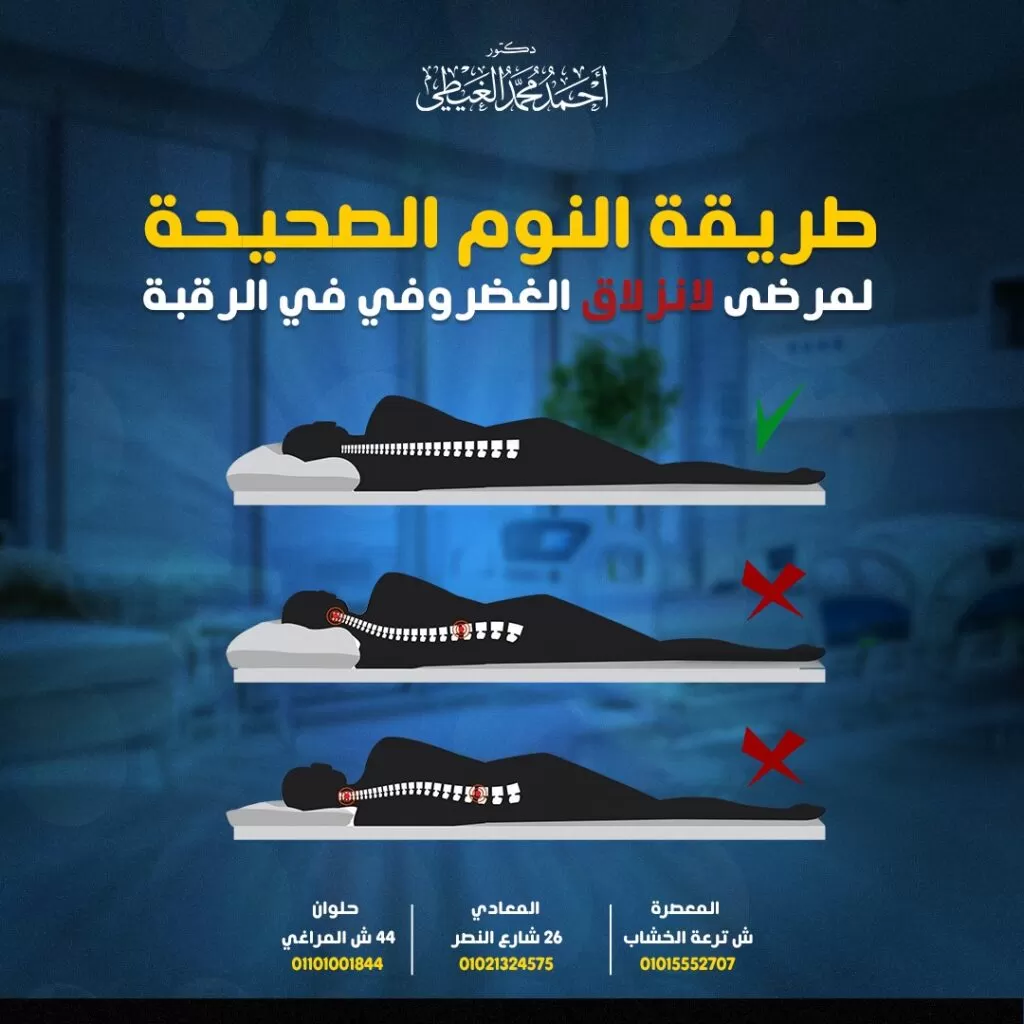 يبحث العديد من مرضى غضروف الرقبة عن طريقة النوم الصحيحة لمرضى الانزلاق الغضروفي في الرقبة لتقليل الشعور بالألم والقدرة على النوم، حيث قد يتسبب الانزلاق الغضروفي العنقي في اضطرابات في أنماط النوم المختلفة لذلك يجب تغيير تلك الأنماط إلى أخرى أكثر راحة. ومن خلال المقال سوف نوضح أكثر الحلول والأوضاع للحصول على نوم مريح بدون ألم. اذًا ما هي طريقة النوم الصحيحة لمرضى الانزلاق الغضروفي في الرقبة؟ سيجيب الدكتور أحمد الغيطي أفضل استشاري جراحة العمود الفقري. جدول المحتوياتطريقة النوم الصحيحة لمرضى الانزلاق الغضروفي في الرقبةللاستفسارات والحجز طريقة النوم الصحيحة لمرضى الانزلاق الغضروفي في الرقبة عادةً يبقى الوضع المحايد الرقبة من أفضل الخيارات المتاحة في اوضاع النوم لتقليل آلام الرقبة، وبالنسبة إلى إصابات الانزلاق الغضروفي العنقي تحديداً يكون النوم على البطن من الأوضاع المحظورة لأنه يتطلب لف العنق 90 درجة تقريبًا حتى تتمكن من التنفس. على العكس، يعد النوم على الجانب أو الظهر من عادةً من أفضل أوضاع النوم لألم الرقبة مع اختيار وسادة بالسمك المناسب لاتسمح بانحناء رأسك كثيرًا للأمام إذا كنت تنام على ظهرك أو بعيدًا جدًا على جانب واحد إذا كنت تنام على جانبك. وفيما يلي شرحاً مفصلا لأوضاع النوم المناسبة في حالات الانزلاق الغضروفي: النوم الجانبي مع وضع وسادة بين الركبتين توجد طريقتان لضبط الوسادة بين ركبتي المريض لتخفيف الشعور بالألم، إما النوم على أحد الجانبين الأيمن أو الأيسر ووضع وسادة بين الساقين مع ضبط الوسادة بحيث يكون الأنف بمحاذاة مركز الجسم ، أي لا تجعل الرأس يميل كثيرًا إلى جانب واحد. أو أن ينام المريض على ظهره مع وضع الوسادة تحت الركبتين. وفي كلتا الحالتين، يساعد ذلك في الحفاظ على منحنى العمود الفقري في وضع طبيعي ومريح. وضع الجنين لمرضي آلام الغضروف في الرقبة يساعد ذلك الوضع على فتح الفقرات العنقية والنوم بسهولة وراحة أكبر عن طريق الاستلقاء على أي من الجانبين ، وثني الجسد مع ثني الركبتين بالقرب من الصدر مع لف الجزء العلوي من الجسم ببطء نحو الركبتين. يفضل تبديل الجوانب كثيرًا لمنع أي اختلال في التوازن. الاستلقاء على الظهر حيث يقوم المريض بالاستلقاء على السرير بنفس وضع الاستلقاء على كرسي مائل بشكل يصنع زاوية بين الجذع والساقين. إذا اخترت أن تنام في وضعية الجلوس او ماتعرف بوضعية الاستلقاء ، يفضل استخدام وسادة الرقبة لمنع انحناء الرأس كثيرًا إلى جانب واحد أو من التمايل إلى الأمام. النوم على البطن بالرغم من كون ذلك الوضع ليس من الأوضاع المفضلة لمرضى الانزلاق الغضروفي، حيث يمنع محاذاة الانحناء الطبيعي للعمود الفقري ويزيد الضغط على الظهر والرقبة. إلا أنه قد يكون من الأوضاع التي توفر المزيد من الراحة للمريض عن طريق الاستلقاء على البطن مع وضع وسادة أسفل المريض تحت الوركين والركبتين وتحريكها حتى تدعم البطن وتصل إلى أقصى راحة ممكنة، والحفاظ على الانحناء المناسب للعمود الفقري لتخفيف الضغط على القرص المنفتق. واعتمادًا على ما يشعر به المريض، فإنه قد لا يحتاج إلى إضافة وسادة للرأس. إذا كنت تنام على بطنك، يجب استخدام وسادة خاصة تسمح بالتنفس أثناء مواجهتك للأمام، حيث يساعد هذا في تقليل الالتواء والضغط على الرقبة. ولكن بغض النظر عن وضع النوم الذي يختاره المريض والذي يوفر له المزيد من الراحة، يجب أن تكون محاذاة العمود الفقري بشكل صحيح هي الأساس في اختيار الوضع. يجب التركيز على محاذاة الأذنين والكتفين والوركين. ولكن في حالة وجود فجوات بين السرير والجسم، يؤدي ذلك إلى الشعور بالمزيد من الإجهاد للعمود الفقري ويجب استخدام الوسائد لملء تلك الفجوات. كما يجب توخي الحذر عند تغيير طريقة النوم ومراعاة عدم الخروج عن المحاذاة أثناء ذلك التغيير. مثلاً عند الدوران ، يجب على المريض أن يحافظ على الجسم مشدود من خلال تحريك الجسم بالكامل في نفس الوقت، ويساعد جذب الركبتين نحو الصدر أثناء التقلب. اختيار المراتب والوسائد المناسبة بجانب اختيار طريقة النوم الصحيحة لمرضى الانزلاق الغضروفي في الرقبة، يجب اختيار المراتب والوسائد المناسبة لأوضاع النوم التي توفر المزيد من الراحة وتخفيف الألم للمريض. المراتب يتم اختيار المرتبة الصحيحة التي تحافظ على توازن العمود الفقري متوازنة وتقلل من الضغط الواقع عليه، وبالتالي تحسين النوم وتقليل ألم الرقبة. وتعد مراتب اللاتكس من أفضل الأنواع في حالات الانزلاق الغضروفي العنقي و الأقراص المنفتقة. الوسائد يتم اختيار وسائد مناسبة لتخفيف الألم الناتج عن انفتاق القرص بالشكل الذي يعزز محاذاة العمود الفقري. يتم تحديد النوع المناسب اعتمادا على وضع النوم بالشكل التالي: النوم على الظهر الأفضل اختيار وسائد متوسطة الارتفاع ما بين 3-5 بوصات لضمان تقديم الدعم المناسب للرقبة دون إجهاد العضلات. النوم على الجنب لمرضي الانزلاق الغضروفي في الرقبة يتم اختيار وسادة عالية بمتوسط 5 بوصات أو أكثر لتقليل الفجوة بين الرقبة والسرير. النوم على البطن يتم اختيار وسادة منخفضة الارتفاع أقل من 3 بوصات لتقليل توتر عضلات الرقبة، و الكتف، والعمود الفقري. النوم في أوضاع مختلفة لعلاج آلام الغضروف في الرقبة تفضل الوسائد ذات الارتفاع المتوسط لا تزيد عن 5 بوصات، للحفاظ على المحاذاة المناسبة لوضع النوم. الخلاصة يجب اختيار طريقة النوم الصحيحة لمرضى الانزلاق الغضروفي في الرقبة والتي تساهم في تخفيف الألم والنوم بمزيد من الاسترخاء والراحة مع ضرورة اختيار الوسائد المناسبة للحالة ووضع النوم وعدم القيام بحركات خاطئة تزيد من ألم الرقبة. أفضل دكتور عمود فقري لعلاج الانزلاق الغضروفي في الرقبة أفضل وأحسن دكتورعمود فقري يقوم بعلاج الانزلاق الغضروفي في الرقبة بالجراحة هو جراح العمود الفقري والتدخل المحدود الذي تدرب على فروع جراحات العمود الفقري والتدخل المحدود متناهية الدقة والميكروسكوبية. سواء باستخدام الميكروسكوب الجراحي أو باستخدام المنظار. كما يجب أن يكون متمكنا من دراسة التاريخ المرضي للحالة بدقة والتأكد من نوع الورم الموجود لدى المريض. ويقوم دكتور أحمد الغيطي باجراء كافة جراحات العمود الفقري والتدخل المحدود سواء ميكروسكوبيا أو بالمنظار المخي لعلاج مرضى الانزلاق الغضروفي في الرقبة. عيادة دكتور أحمد الغيطي استشاري جراحة العمود الفقري والتدخل المحدود اقرأ أيضا: (مصادر) الغضروف القطني وعرق النسا متى نلجأ لعملية تبخير الغضروف؟ طريقة النوم الصحيحة لمرضى الانزلاق الغضروفي في الرقبة فى عيادات دكتور أحمد الغيطي نحرص على اتباع الخطوات اللازمة للتعرف على حالتك وبناء خطة علاجية فعالة. اضغط هنا لحجز موعد في عيادة دكتور أحمد الغيطي لعلاج انزلاق غضروفي في الرقبة بالجراحة دكتور أحمد الغيطي لعلاج الانزلاق الغضروفي في الرقبة استشاري جراحة المخ والأعصاب والعمود الفقري. استشاري القسطرة المخية التداخلية وجراحات المخ والأعصاب الوظيفية وجراحة الصرع. دكتوراه جراحة المخ والأعصاب – كلية طب القصر العيني – جامعة القاهرة. زميل البورد الأوربي للجراحات العصبية (FEBNS). تابعونا على صفحة الفيسبوك من هنا صفحة الفيسبوك للاستفسارات والحجز عيادة المعادي: 26 شارع النصر أعلى فودافون ت/ 01021324575 الانزلاق الغضروفي في الرقبة وطريقة النوم الصحيحة للمرضي يبحث العديد من مرضى غضروف الرقبة عن طريقة النوم الصحيحة لمرضى الانزلاق الغضروفي في الرقبة لتقليل الشعور بالألم والقدرة على النوم، حيث قد يتسبب الانزلاق الغضروفي العنقي في اضطرابات في أنماط النوم المختلفة لذلك يجب تغيير تلك الأنماط إلى أخرى أكثر راحة. ومن خلال المقال سوف نوضح أكثر الحلول والأوضاع للحصول على نوم مريح بدون ألم. اذًا ما هي طريقة النوم الصحيحة لمرضى الانزلاق الغضروفي في الرقبة؟ سيجيب الدكتور أحمد الغيطي أفضل استشاري جراحة العمود الفقري. احجز الآن مع دكتور أحمد الغيطي من هنا جدول المحتويات طريقة النوم الصحيحة لمرضى الانزلاق الغضروفي في الرقبة للاستفسارات والحجز طريقة النوم الصحيحة لمرضى الانزلاق الغضروفي في الرقبة عادةً يبقى الوضع المحايد الرقبة من أفضل الخيارات المتاحة في اوضاع النوم لتقليل آلام الرقبة، وبالنسبة إلى إصابات الانزلاق الغضروفي العنقي تحديداً يكون النوم على البطن من الأوضاع المحظورة لأنه يتطلب لف العنق 90 درجة تقريبًا حتى تتمكن من التنفس. على العكس، يعد النوم على الجانب أو الظهر من عادةً من أفضل أوضاع النوم لألم الرقبة مع اختيار وسادة بالسمك المناسب لاتسمح بانحناء رأسك كثيرًا للأمام إذا كنت تنام على ظهرك أو بعيدًا جدًا على جانب واحد إذا كنت تنام على جانبك. وفيما يلي شرحاً مفصلا لأوضاع النوم المناسبة في حالات الانزلاق الغضروفي: النوم الجانبي مع وضع وسادة بين الركبتين توجد طريقتان لضبط الوسادة بين ركبتي المريض لتخفيف الشعور بالألم، إما النوم على أحد الجانبين الأيمن أو الأيسر ووضع وسادة بين الساقين مع ضبط الوسادة بحيث يكون الأنف بمحاذاة مركز الجسم ، أي لا تجعل الرأس يميل كثيرًا إلى جانب واحد. أو أن ينام المريض على ظهره مع وضع الوسادة تحت الركبتين. وفي كلتا الحالتين، يساعد ذلك في الحفاظ على منحنى العمود الفقري في وضع طبيعي ومريح. وضع الجنين لمرضي آلام الغضروف في الرقبة يساعد ذلك الوضع على فتح الفقرات العنقية والنوم بسهولة وراحة أكبر عن طريق الاستلقاء على أي من الجانبين ، وثني الجسد مع ثني الركبتين بالقرب من الصدر مع لف الجزء العلوي من الجسم ببطء نحو الركبتين. يفضل تبديل الجوانب كثيرًا لمنع أي اختلال في التوازن. الاستلقاء على الظهر حيث يقوم المريض بالاستلقاء على السرير بنفس وضع الاستلقاء على كرسي مائل بشكل يصنع زاوية بين الجذع والساقين. إذا اخترت أن تنام في وضعية الجلوس او ماتعرف بوضعية الاستلقاء ، يفضل استخدام وسادة الرقبة لمنع انحناء الرأس كثيرًا إلى جانب واحد أو من التمايل إلى الأمام. النوم على البطن بالرغم من كون ذلك الوضع ليس من الأوضاع المفضلة لمرضى الانزلاق الغضروفي، حيث يمنع محاذاة الانحناء الطبيعي للعمود الفقري ويزيد الضغط على الظهر والرقبة. إلا أنه قد يكون من الأوضاع التي توفر المزيد من الراحة للمريض عن طريق الاستلقاء على البطن مع وضع وسادة أسفل المريض تحت الوركين والركبتين وتحريكها حتى تدعم البطن وتصل إلى أقصى راحة ممكنة، والحفاظ على الانحناء المناسب للعمود الفقري لتخفيف الضغط على القرص المنفتق. واعتمادًا على ما يشعر به المريض، فإنه قد لا يحتاج إلى إضافة وسادة للرأس. إذا كنت تنام على بطنك، يجب استخدام وسادة خاصة تسمح بالتنفس أثناء مواجهتك للأمام، حيث يساعد هذا في تقليل الالتواء والضغط على الرقبة. ولكن بغض النظر عن وضع النوم الذي يختاره المريض والذي يوفر له المزيد من الراحة، يجب أن تكون محاذاة العمود الفقري بشكل صحيح هي الأساس في اختيار الوضع. يجب التركيز على محاذاة الأذنين والكتفين والوركين. ولكن في حالة وجود فجوات بين السرير والجسم، يؤدي ذلك إلى الشعور بالمزيد من الإجهاد للعمود الفقري ويجب استخدام الوسائد لملء تلك الفجوات. كما يجب توخي الحذر عند تغيير طريقة النوم ومراعاة عدم الخروج عن المحاذاة أثناء ذلك التغيير. مثلاً عند الدوران ، يجب على المريض أن يحافظ على الجسم مشدود من خلال تحريك الجسم بالكامل في نفس الوقت، ويساعد جذب الركبتين نحو الصدر أثناء التقلب. اختيار المراتب والوسائد المناسبة بجانب اختيار طريقة النوم الصحيحة لمرضى الانزلاق الغضروفي في الرقبة، يجب اختيار المراتب والوسائد المناسبة لأوضاع النوم التي توفر المزيد من الراحة وتخفيف الألم للمريض. المراتب يتم اختيار المرتبة الصحيحة التي تحافظ على توازن العمود الفقري متوازنة وتقلل من الضغط الواقع عليه، وبالتالي تحسين النوم وتقليل ألم الرقبة. وتعد مراتب اللاتكس من أفضل الأنواع في حالات الانزلاق الغضروفي العنقي و الأقراص المنفتقة. الوسائد يتم اختيار وسائد مناسبة لتخفيف الألم الناتج عن انفتاق القرص بالشكل الذي يعزز محاذاة العمود الفقري. يتم تحديد النوع المناسب اعتمادا على وضع النوم بالشكل التالي: النوم على الظهر الأفضل اختيار وسائد متوسطة الارتفاع ما بين 3-5 بوصات لضمان تقديم الدعم المناسب للرقبة دون إجهاد العضلات. النوم على الجنب لمرضي الانزلاق الغضروفي في الرقبة يتم اختيار وسادة عالية بمتوسط 5 بوصات أو أكثر لتقليل الفجوة بين الرقبة والسرير. النوم على البطن يتم اختيار وسادة منخفضة الارتفاع أقل من 3 بوصات لتقليل توتر عضلات الرقبة، و الكتف، والعمود الفقري. النوم في أوضاع مختلفة لعلاج آلام الغضروف في الرقبة تفضل الوسائد ذات الارتفاع المتوسط لا تزيد عن 5 بوصات، للحفاظ على المحاذاة المناسبة لوضع النوم. الخلاصة يجب اختيار طريقة النوم الصحيحة لمرضى الانزلاق الغضروفي في الرقبة والتي تساهم في تخفيف الألم والنوم بمزيد من الاسترخاء والراحة مع ضرورة اختيار الوسائد المناسبة للحالة ووضع النوم وعدم القيام بحركات خاطئة تزيد من ألم الرقبة. أفضل دكتور عمود فقري لعلاج الانزلاق الغضروفي في الرقبة أفضل وأحسن دكتورعمود فقري يقوم بعلاج الانزلاق الغضروفي في الرقبة بالجراحة هو جراح العمود الفقري والتدخل المحدود الذي تدرب على فروع جراحات العمود الفقري والتدخل المحدود متناهية الدقة والميكروسكوبية. سواء باستخدام الميكروسكوب الجراحي أو باستخدام المنظار. كما يجب أن يكون متمكنا من دراسة التاريخ المرضي للحالة بدقة والتأكد من نوع الورم الموجود لدى المريض. ويقوم دكتور أحمد الغيطي باجراء كافة جراحات العمود الفقري والتدخل المحدود سواء ميكروسكوبيا أو بالمنظار المخي لعلاج مرضى الانزلاق الغضروفي في الرقبة. أفضل دكتور مخ وأعصاب لعلاج أورم المخ عند الأطفال عيادة دكتور أحمد الغيطي استشاري جراحة العمود الفقري والتدخل المحدود اقرأ أيضا: (مصادر) الغضروف القطني وعرق النسا متى نلجأ لعملية تبخير الغضروف؟ طريقة النوم الصحيحة لمرضى الانزلاق الغضروفي في الرقبة فى عيادات دكتور أحمد الغيطي نحرص على اتباع الخطوات اللازمة للتعرف على حالتك وبناء خطة علاجية فعالة. اضغط هنا لحجز موعد في عيادة دكتور أحمد الغيطي لعلاج انزلاق غضروفي في الرقبة بالجراحة دكتور أحمد الغيطي لعلاج الانزلاق الغضروفي في الرقبة استشاري جراحة المخ والأعصاب والعمود الفقري. استشاري القسطرة المخية التداخلية وجراحات المخ والأعصاب الوظيفية وجراحة الصرع. دكتوراه جراحة المخ والأعصاب – كلية طب القصر العيني – جامعة القاهرة. زميل البورد الأوربي للجراحات العصبية (FEBNS). تابعونا على صفحة الفيسبوك من هنا صفحة الفيسبوك للاستفسارات والحجز عيادة المعادي: 26 شارع النصر أعلى فودافون ت/ 01021324575 وعيادة حلوان: 44 شارع المراغي بجوار محطة مترو حلوان ت: 01101001844 عيادة المعصرة: ش ترعة الخشاب فوق كافيتيريا اللؤلؤة ت/ 01015552707 احجز الآن مع دكتور أحمد الغيطي من هنا