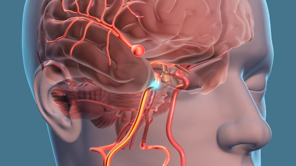 ما هي دواعي إجراء قسطرة المخ؟
