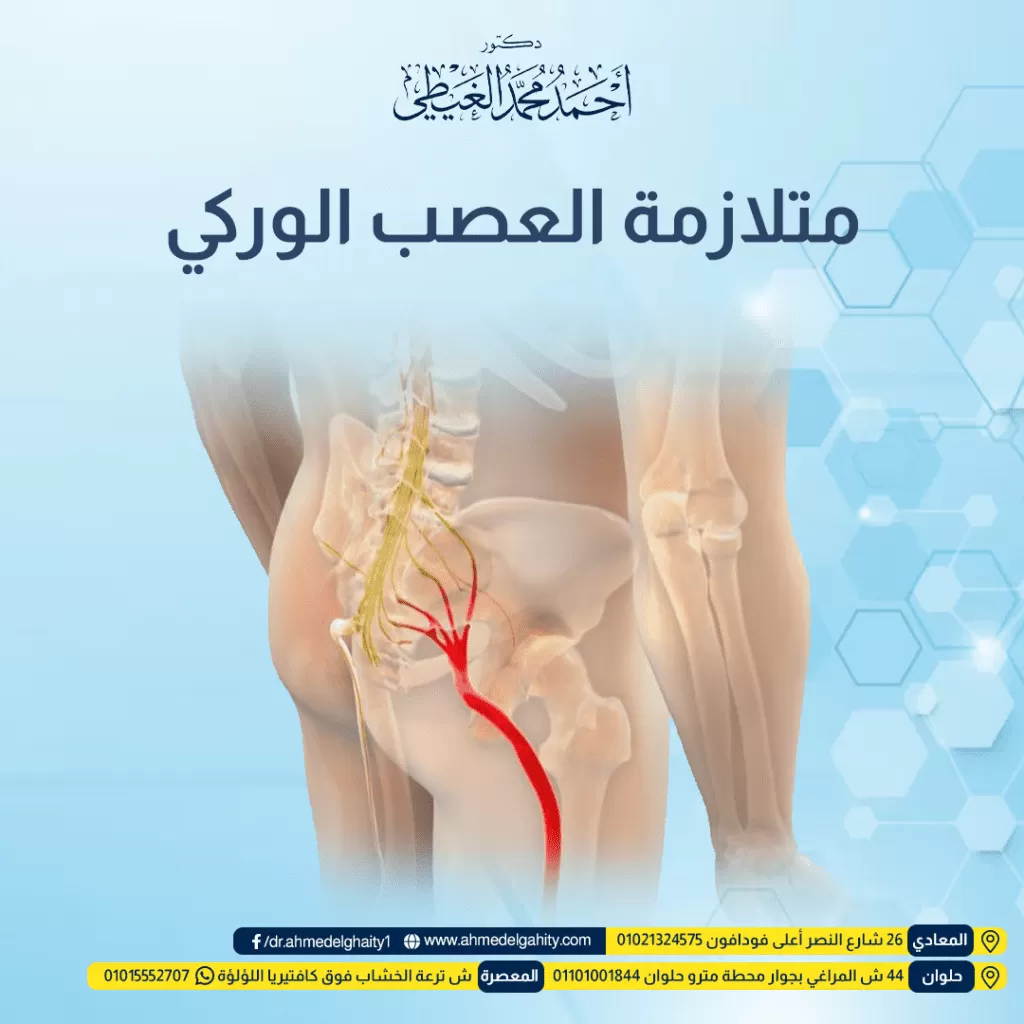 متلازمة العصب الوركي متلازمة العضلة الكمثرية