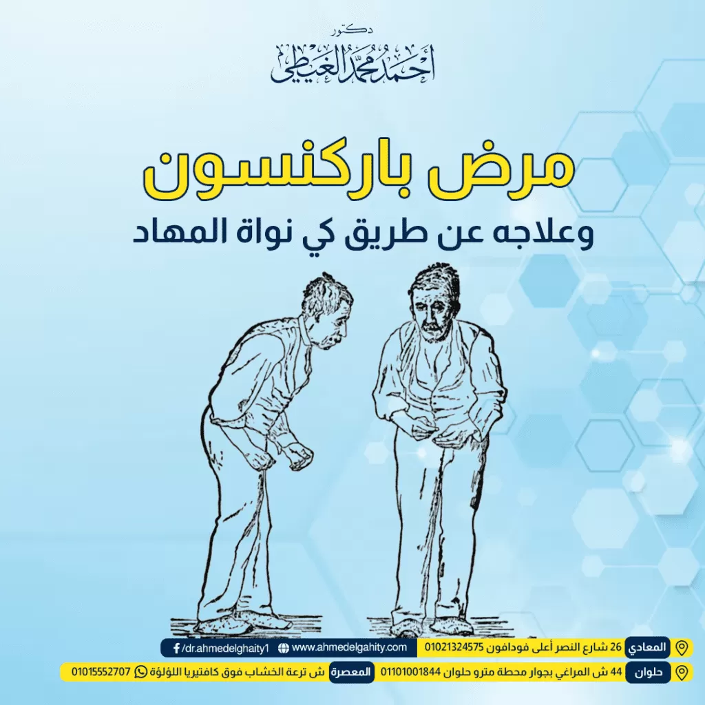 مرض باركنسون وعلاجه عن طريق كي نواة المهاد