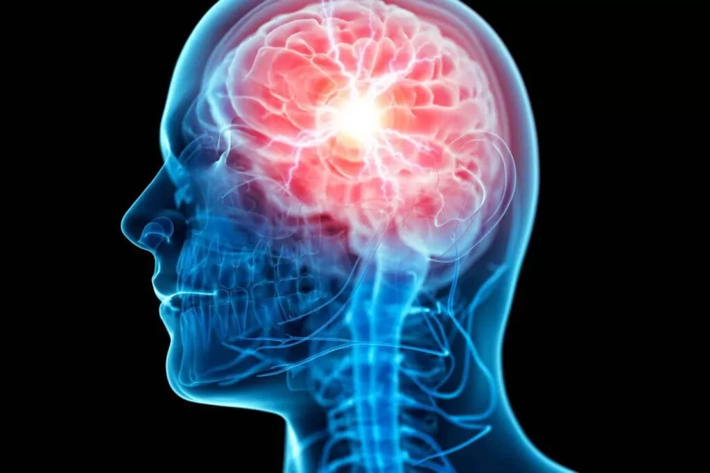 أعراض الكهرباء الزائدة في المخ للكبار
أعراض الكهرباء الزائدة في المخ للكبار تبدو واضحة ويعاني منها صاحبها كثيراً وخاصة من قبل الأشخاص المحيطة حوله، ولذلك نجد دائماً الشخص المصاب يبحث عن طرق العلاج التي يمكن من خلالها القضاء على الأعراض والآلام الشديدة. وكذلك طرق التشخيص الصحيحة لتحديد الحالة بوضوح والأسباب التي أدت لحدوث هذه المشكلة وغير ذلك، وهذا ما سوف نقوم بتوضيحه كاملاً داخل المقال من خلال موقع دكتور أحمد الغيطي.
احجز الآن مع دكتور أحمد الغيطي من هنا
جدول المحتويات
ما هي الكهرباء الزائدة في المخ؟
أعراض الكهرباء الزائدة في المخ للكبار
أسباب الكهرباء الزائدة في المخ للكبار
طرق تشخيص أعراض الكهرباء الزائدة في المخ
للاستفسارات والحجز
ما هي الكهرباء الزائدة في المخ؟
سوف نقوم بذكر أعراض الكهرباء الزائدة في المخ للكبار في السطور التالية ولكن دعنا الآن نتحدث عن ماهية الكهرباء الزائدة التي تحدث في المخ، لنتعرف عليها من خلال النقاط التالية:
تحدث الكهرباء الزائدة في المخ عند زيادة النبضات الكهربائية إلى أضعاف مضاعفة عن المعدل الطبيعي لها داخل الخلايا العصبية التي توجد في منطقة المخ.
يطلق عليه هذا الاسم نتيجة الواقع الذي يتعرض له المريض من الأشخاص التي تحيط به.
يوجد أيضاً مصطلح آخر لها وهو الطاقة الكهربائية الكامنة التي تنتشر في جسم الإنسان وتكون واضحة عندما يلامس الجسم العديد من الأسطح الخارجية كرد فعل للتفاعل الذي يحدث بين الجسم وبين تلك الأجسام.
هناك الكثير من الأسباب التي تؤدي لحدوث تلك الكهرباء الزائدة، منها على سبيل المثال حدوث إصابة شديدة في الرأس أو قلة وجود الأكسجين داخل الخلايا الموجودة في المخ وغير ذلك من الأسباب التي سوف نقوم بذكرها بالتفصيل في السطور التالية.
يمكن السيطرة على أعراض الكهرباء الزائدة في المخ عند بعض المرضى من خلال استعمال الأدوية التي تناسب كل حالة.
أعراض الكهرباء الزائدة في المخ للكبار
أعراض الكهرباء الزائدة في المخ للكبار
يوجد الكثير من أعراض الكهرباء الزائدة في المخ، وسوف نذكر الأشهر من بينهم من خلال الآتي:
فقدان الوعي أو الدوخة الشديدة من أهم الأعراض التي تبدو بوضوح على مرضى الصرع الجزئي.
إحساس المصاب بتنميل شديد في الأطراف مع فقدان القدرة على الحواس الخمس وهم (اللمس والتذوق والسمع بالإضافة إلى الشم والنظر).
عدم استطاعة المريض على الاستجابة للعديد من الأشياء بالإضافة إلى تكرار معظم الحركات بشكل لا إرادي وحدوث تصلب شديد في العضلات.
حدوث ارتخاء شديد في العضلات مما يسبب سقوط المصاب كرد فعل لعدم قدرته على التحكم في عضلاته.
يتعرض المصاب إلى الارتعاش في العضلات بطريقة مستمرة وبشكل خاص تلك الموجودة في اليدين والرقبة وكذلك الوجه، حيث تعتبر من أشهر أعراض الكهرباء الزائدة.
حدوث التشنجات القصيرة التي يتفاجأ بها المصاب في كلا من أطراف الساقين واليدين.
تعرض المصاب إلى ما يسمى بـالنوبات التوترية الرمعية ومن أهم أعراضها، تصلب الجسم، حدوث الإغماء، عدم التحكم في المثانة، عض اللسان، حدوث رعشة شديدة في العضلات الخاصة بالجسم.
اقرأ أيضًا: العلاج الكيميائي لورم المخ
أسباب الكهرباء الزائدة في المخ للكبار
أسباب الكهرباء الزائدة في المخ للكبار
بعد أن تعرفنا على أعراض الكهرباء الزائدة في المخ للكبار نستطيع الآن ذكر الأسباب التي تؤدي لحدوث الكهرباء في المخ، ومن أجل المصداقية ليس هناك أسباب واضحة ومؤكدة لكثير من الحالات التي تتعرض لذلك وعلى الرغم من ذلك يوجد معظم الأسباب التي تعمل على زيادة الكهرباء في المخ، وسوف نقوم بعرضها من خلال النقاط التالية:
تعرض الشخص لفترات طويلة إلى الموجات الكهرومغناطيسية، حيث تسبب خطر شديد على المخ منها على سبيل المثال جهاز المحمول أو الكمبيوتر أو الجلوس لفترات طويلة أمام التلفاز، حيث يسبب هذا الأمر زيادة الأعراض المتعلقة بكهرباء المخ ولكن لا يمكن أن نعتبرها السبب الرئيسي في حدوث ذلك.
حدوث ورم في المخ.
تناول معظم الأدوية التي لا تتناسب مع هذا المرض منها على سبيل المثال الترامادول والعديد من المنشطات الأخرى أخطر أسباب الكهرباء الزائدة في المخ للكبار.
إصابة الشخص بمعظم الأمراض العصبية التي تؤثر على المخ بشكل مباشر.
تعرض الشخص إلى معظم الأمراض المتعلقة بالجهاز المناعي منها على سبيل المثال التهاب السحايا والتهاب الدماغ ببعض الفيروسات بالإضافة إلى مرض الإيدز.
إصابة المرأة بتلف شديد في منطقة الدماغ أو جرح معين أثناء القيام بعملية الولادة أحد أسباب الكهرباء الزائدة في المخ للكبار.
تعرض الشخص إلى ضربة تتصف بالقوة في الدماغ نتيجة بعض الحوادث الشديدة.
معاناة الشخص من معظم المشاكل الصحية التي يتعرض لها الدماغ منها على سبيل المثال السكتة الدماغية التي تعد من أكثر الأسباب الرئيسية لظهور أعراض الكهرباء الزائدة في المخ للكبار.
تعرض الشخص إلى مرض الزهايمر أو أي حالة مشابهة له.
قلة وصول الأكسجين إلى الخلايا الموجودة في الدماغ.
تزيد فرصة إصابة الأشخاص بالكهرباء السائدة عند المتقدمين في العمر، حيث 65 سنة أو أكثر، وكذلك ينتشر بكثرة عند الأطفال الذين لم يصل عمرهم إلى سنتين.
حدوث معظم الاضطرابات الوراثية التي تتعلق بالجينات تسبب إصابة الشخص بهذا المرض.
التعرض إلى الحمى الشديدة التي لا تقل بل تستمر أكثر، بالإضافة إلى الأمراض الشديدة المشابهة للحمى.
اقرأ أيضًا: العلاج الإشعاعي لورم المخ
طرق تشخيص أعراض الكهرباء الزائدة في المخ
يوجد الكثير من الطرق التشخيصية التي يقوم بها دكتور أحمد الغيطي استشاري جراحة المخ والأعصاب وجراحات الصرع من أجل معرفة أسباب حدوث هذه الأعراض ومساعدة المريض على توفير العلاج المناسب لها وتوفير الحل الفعلي للتخلص منها سواء بشكل نهائي أو على الأقل التخفيف من حدوثها أو من المضاعفات الناتجة عنها، ومن أشهر هذه الطرق ما يلي:
قيام المريض بمعظم الفحوصات المخبرية والتصويرية من أجل معرفة الأسباب الناتجة عن حدوث هذه الأعراض والحجم الذي وصلت إليه الإصابة إليه، بالإضافة إلى إجراء بعض التحاليل، وبناءً على ذلك يقوم دكتور أحمد الغيطي بتحديد البرنامج المناسب للعلاج.
يجب إجراء بعض الفحوصات الشاملة للدم التي يمكن من خلالها توضيح المشاكل الصحية التي يعاني منها المريض سواء فقر الدم أو الإصابة بمرض السكر أو غير ذلك.
يحتاج دكتور أحمد الغيطي في بعض الأوقات من المريض إجراء بعض الفحوصات التي تعرف باسم التحفيز الكهربي للدماغ أو باختصار رسم المخ (EEG) وهذا الأمر ضروري عند تعرض الشخص إلى نوبات شديدة من الصرع التي تحتاج لرسم مخ على مدار يوم كامل.
قيام المريض بعمل أشعة مقطعية على المخ لمعرفة الأسباب وكذلك جميع أعراض الكهرباء الزائدة في المخ.
يسأل دكتور أحمد الغيطي استشاري جراحة الصرع المريض مجموعة من الأسئلة من أجل معرفة الطريقة التي يفكر بها والتأكد من صحة الذاكرة والمستوى الطبيعي للإدراك، حيث يمكنه من خلال هذه الأسئلة معرفة الأداء الوظيفي لكافة الحواس الموجودة في الجسم بالإضافة إلى صحة العضلات والجهاز الحركي.
يحتاج المصاب إلى التصوير باستخدام الرنين المغناطيسي من أجل أخذ معظم الصور بشكل تفصيلي التي تكون ثلاثية الأبعاد لمعرفة حجم الإصابة بالتحديد من الداخ ويعتبر الرنين المغناطيسي على المخ من أدق الطرق لفحص النسيج العصبي المركزي عموما والمخ خصوصا.
وضع المريض على بعض الأجهزة المتعلقة برسم المخ التي تعتمد في الأساس على إرسال مجموعة من الشحنات الكهربائية لجميع الخلايا الموجودة في المخ من خلال أسلاك معينة يقوم المختص بوضعها بطريقة معينة على رأس المريض، وبالتالي تقوم بتسجيل كافة الإشارات الكهربائية التي يقوم المخ بإصدارها على هيئة موجات من أجل التعرف على حجم الإصابة ووضع البرنامج العلاجي المناسب.
وصلنا بذلك إلى نهاية مقالنا بعد أن ذكرنا فيه أعراض الكهرباء الزائدة في المخ للكبار وكذلك الأسباب وغير ذلك من المعلومات التي يحتاجها أي مصاب من هذا النوع راجين من الله الشفاء للجميع.
مراجع داخلية:
أمراض الاضطرابات الحركية وعلاجها
جراحات المخ والأعصاب الوظيفية
أفضل دكتور لعلاج الكهرباء الزائدة المقاومة للعلاج في المخ للكبار
أفضل وأحسن دكتور مخ وأعصاب يقوم بعلاج الكهرباء الزائدة في المخ المقاومة للعلاج للكبار بالجراحة هو جراح المخ والأعصاب الذي تدرب على فروع جراحات المخ والأعصاب متناهية الدقة والميكروسكوبية. سواء باستخدام الميكروسكوب الجراحي أو باستخدام منظار المخ. كما يجب أن يكون متمكنا من دراسة التاريخ المرضي للحالة بدقة والتأكد من النوبات الصرعية الموجودة لدى المريض وأنها مقاومة لأنواع علاج الصرع المختلفة. ويقوم دكتور أحمد الغيطي باجراء كافة جراحات المخ والاعصاب سواء ميكروسكوبيا أو بالمنظار المخي لعلاج أنواع الصرع المقاوم للعلاج جراحيا.
أفضل دكتور مخ وأعصاب لعلاج أورم المخ عند الأطفال
عيادة دكتور أحمد الغيطي استشاري جراحة المخ والأعصاب والعمود الفقري
اقرأ أيضا: (مصادر)
علامات الشفاء من الصرع
أعراض نوبات الصرع
أدوية علاج الصرع
جراحة الصرع
علاج الصرع نهائيا بالجراحة
الصرع والتشنجات
الشلل الرعاش والصرع
مراجع داخلية: اعراض ورم المخ وعلاجه
فى عيادات دكتور أحمد الغيطي نحرص على اتباع الخطوات اللازمة للتعرف على حالتك وبناء خطة علاجية فعالة.
اضغط هنا لحجز موعد في عيادة دكتور أحمد الغيطي لعلاج الكهرباء الزائدة المقاومة للعلاج في المخ للكبار
دكتور أحمد الغيطي
استشاري جراحة المخ والأعصاب والعمود الفقري.
استشاري القسطرة المخية التداخلية وجراحات المخ والأعصاب الوظيفية وجراحة الصرع.
دكتوراه جراحة المخ والأعصاب – كلية طب القصر العيني – جامعة القاهرة.
زميل البورد الأوربي للجراحات العصبية (FEBNS).
تابعونا على صفحة الفيسبوك من هنا
صفحة الفيسبوك
للاستفسارات والحجز
عيادة المعادي: 26 شارع النصر أعلى فودافون ت/ 01021324575
وعيادة حلوان: 44 شارع المراغي بجوار محطة مترو حلوان ت: 01101001844
عيادة المعصرة: ش ترعة الخشاب فوق كافيتيريا اللؤلؤة ت/ 01015552707
احجز الآن مع دكتور أحمد الغيطي من هنا