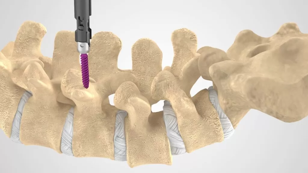 أعراض تظهر بعد إجراء عملية تثبيت الفقرات