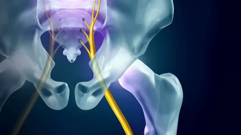 أهم أدوية لعلاج التهاب العصب الوركي