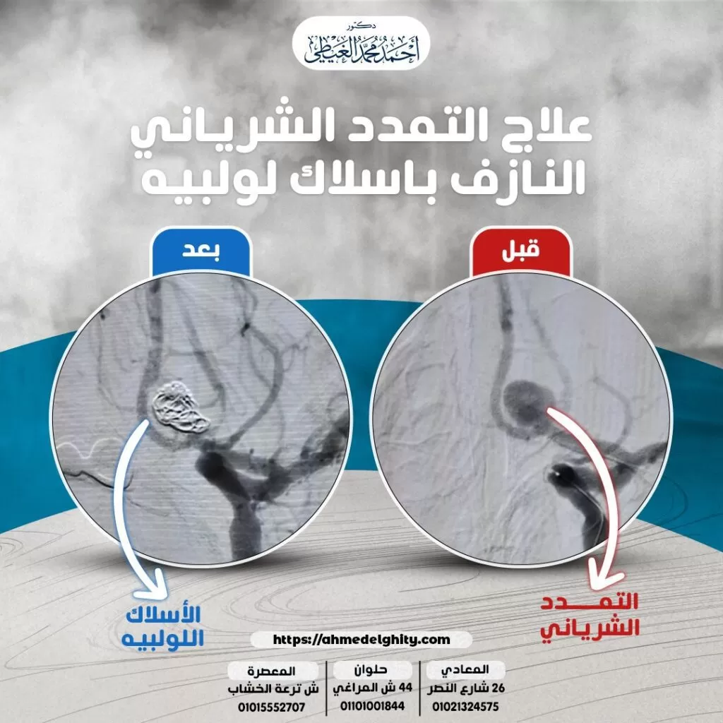 تشخيص التمدد الشرياني بالمخ