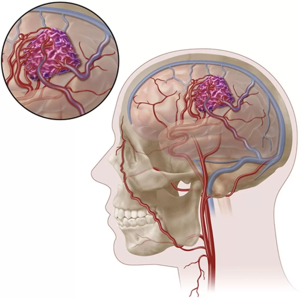 تشخيص التشوه الشرياني الوريدي المخي