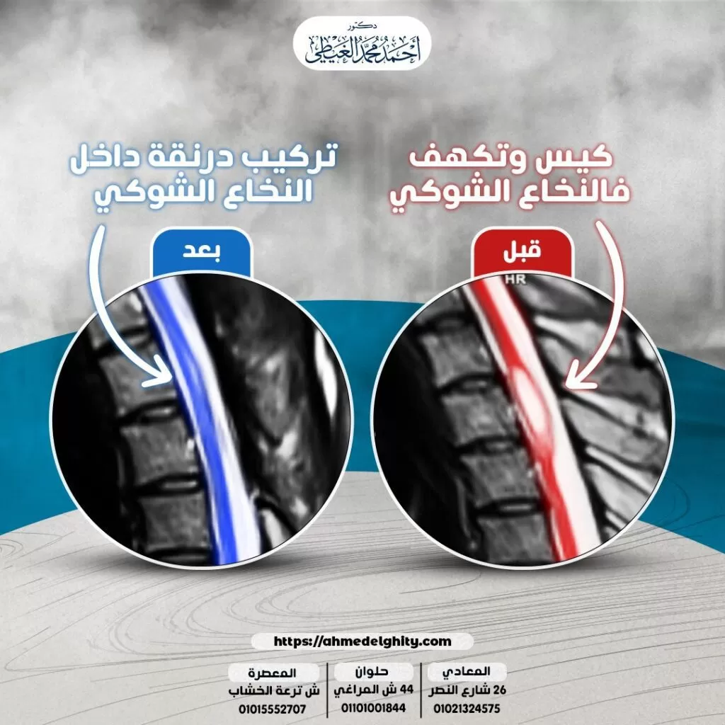 علاج تكيس النخاع الشوكي