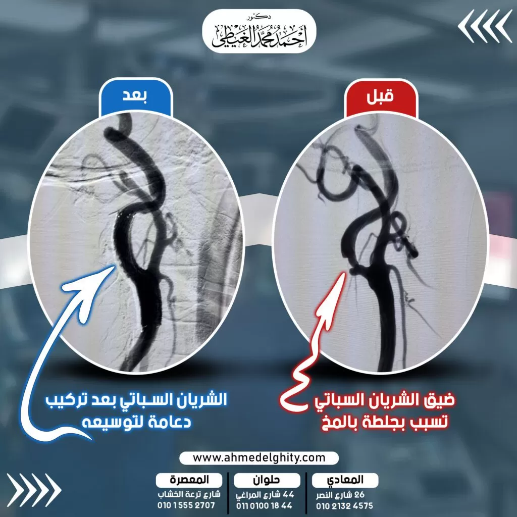 وتحسنت حالة المريض تماما بعد الجراحة خصوصا نوبات ضعف الاحساس والحركة التي كان يصاب بها, وازداد معدل التروية الدموية للمخ, ولم يعاني المريض من أي جلطات أخرى منذ تركيب الدعامة. دكتور مخ واعصاب افضل دكتور لعلاج الحبل الشوكي في مصر استشاري مخ واعصاب مخ واعصاب المخ والاعصاب والعمود الفقري استشارى مخ واعصاب دكتور عمود فقرى دكتور مخ و اعصاب دكتور جراحة مخ واعصاب د مخ واعصاب دكتور مخ واعصاب وعمود فقري دكتور مخ وأعصاب دكتور المخ والاعصاب أشهر جراحي المخ والاعصاب جراحة المخ والاعصاب أشهر دكتور مخ واعصاب افضل دكتور جراحة أورام مخ واعصاب في مصر مخ وأعصاب دکتور فيزيتا مخ واعصاب دكتور اوعية دموية بحلوان د مخ واعصاب اسيوط علاج ضغط الفقرات القطنية اشطر دكتور مخ واعصاب في اسيوط افضل دكتور مخ واعصاب اطفال في اسيوط دكتور اوعية دموية حلوان افضل دكتور اوعية دموية د احمد دكتور جراحة محمد الغيطي عياده مخ واعصاب افضل دكتور مخ واعصاب في مصر الجديدة تخصص جراحة المخ والاعصاب في مصر دكتور اوعية دموية في حلوان ضغط فقرات الرقبة على الشريان هل تنميل الرأس خطير افضل دكتور مخ واعصاب اطفال في مصر افضل دكتور جراحة افضل دكتور مخ واعصاب في طنطا افضل دكتور جراحة اورام في مصر افضل دكتور مخ واعصاب طنطا دكتور اطفال المعادي دكتور مخ واعصاب اطفال دكتور مخ واعصاب اطفال القاهرة افضل دكتور اورام في القاهرة دكتور جراحه علاج ضغط فقرات الظهر على العصب افضل دكتور عمود فقري في مصر الجديدة هل مرض التهاب النخاع الشوكي خطير افضل دكتور جراحة مخ واعصاب في الشرقية ما هو ضمور المخ دكتور مخ واعصاب مستشفى السلام الدولي اعراض الفقرات القطنية أفضل دكتور عظام وعمود فقري في مصر افضل دكتور جراحة عامة في القاهرة افضل دكتور مخ واعصاب في الشرقية أعراض الغضروف الظهر عيادات الشفاء اسماء فقرات العمود الفقري موقع بلاك بورد جامعة القاهرة أعراض غضروف الظهر دكتور مخ و اعصاب اطفال افضل دكتور جراحة اطفال في القاهرة الدكتور احمد دكتور اوعية دموية القاهرة أفضل دكتور لعلاج اعوجاج العمود الفقري جلطة المخيخ عنوان دكتور جراحة اورام دكتور الأعصاب ماذا يعالج دكتور جراحة اورام بالقاهرة احسن دكتور اورام في القاهرة تنميل الدماغ شكل الورم الحميد بالصور التهاب اعصاب الرقبة اعراض التهاب النخاع الشوكي افضل دكتور قلب في المعادي دكتور اوعية دموية المعادي افضل دكتور علاج الألم في مصر اعراض المخ والاعصاب أعراض الورم الحميد اعراض غضروف الظهر اعراض الغضروف الظهر دكتور جراحة عامة القاهرة اكبر دكتور اورام فى مصر علاج الفقرات القطنية اعراض سرطان العمود الفقري ما هي اعراض الغضروف اسباب تنميل الدماغ أعراض الغضروف في الظهر ماهو الانزلاق الغضروفي تخصص مخ واعصاب