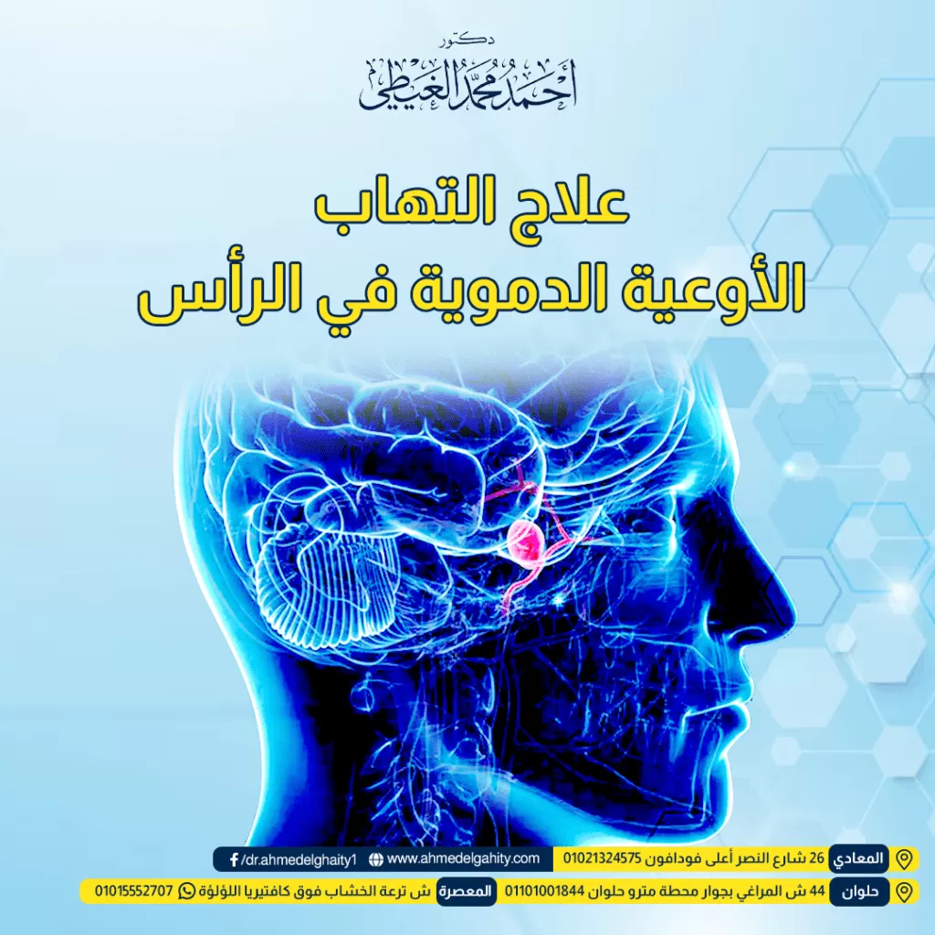 علاج التهاب الأوعية الدموية في الرأس