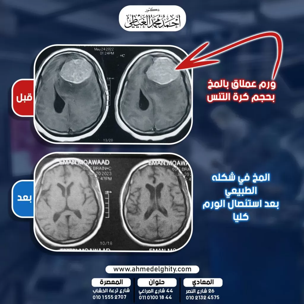 علاج ورم المخ بالميكروسكوب يرى دكتور أحمد الغيطي استشاري جراحة المخ والاعصاب والقسطرة المخية التداخلية أن تقدم علم جراحة المخ والأعصاب مرتبط بشدة بالتطور والتقدم في التكنولوجيا. والتي زادت قدرة الجراحين على التعامل مع اصعب أنواع الحالات وأكثر أنواع الاورام تعقيدا فالحجم أو المكان أو الطبيعة الخلوية. ولكن في الوقت نفسه يجب أن يكون جراح المخ والأعصاب الكفء مدربا بشكل جيد جدا على التعامل مع تلك الوسائل التكنولوجية الحديثة مما يرفع نسبة نجاح الجراحات ويقلل جدا نسب حدوث مضاعفات ما بعد الجراحة. الصورة توضح أحد الحالات التي قام دكتور أحمد الغيطي بعلاجها. وهي مريضة كانت تعاني من ورم عملاق بالمخ ضاغط على النصف الأيسر بالكامل وضاغط على بطينات المخ وأدى لحدوث فتق في النسيج المخي. وقام دكتور احمد الغيطي والفريق المعاون باستئصال الورم بالميكروسكوب الجراحي متناهي الدقة. وتحسنت الحالة تماما من أعراض ما قبل الجراحة. والأشعة توضح حال المخ بعد اكتمال مرور ستة أشهر بعد الجراحة. دكتور أحمد الغيطي إستشاري جراحة المخ والأعصاب والعمود الفقري. ◾️دكتوراة جراحة المخ والأعصاب كلية طب القصر العيني - جامعة القاهرة ◾️عضو مجلس نقابة أطباء القاهرة ◾️زميل البورد الأوروبي للجراحات العصبية FEBNS ◾️عضو الجمعية الأوروبية لجراحات المخ والأعصاب EANS ◾️عضو الجمعية الأمريكية للجراحات العصبية AANS ◾️عضو الكونجرس العالمي لجراحي المخ والأعصاب CNS ◾️عضو الأكاديمية الأوروبية لعلوم الأعصاب EAN _____________________________________________________ أرقام وعناواين العيادات: 📌المعادي: 26 شارع النصر أعلى فودافون - 01015552707 📌المعصرة: ش ترعة الخشاب فوق كافتيريا اللؤلؤة - 01021324575 📌حلوان: ٤٤ ش المراغي بجوار محطة مترو حلوان - 01101001844