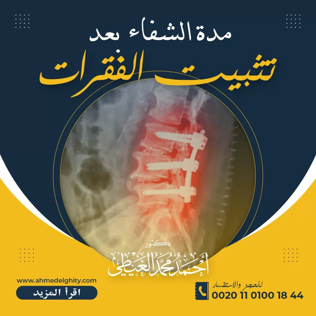 مدة الشفاء من عملية تثبيت الفقرات مدة الشفاء من عملية تثبيت الفقرات يبحث عنها بعض الأشخاص نتيجة الخوف الشديد من المخاطر الناتجة عن إجراء تلك العملية داخل العمود الفقري وبالتالي هؤلاء الأشخاص يحتاجون دائماً إلى التوعية بكل ما يتعلق بإجراء هذه العملية قبل أن يحكمون على نسبة نجاحها أو الشفاء منه وفي هذا المقال سوف نقوم بتوضيح كل ما يتعلق بتلك العملية من خلال موقع دكتور أحمد الغيطي. ما المقصود بعملية تثبيت الفقرات؟ قبل أن تعرف مدة الشفاء من عملية تثبيت الفقرات يجب أولاً التحدث عن هذه العملية وشرح بعض المعلومات المتعلقة بها، ولمعرفة ذلك تابع النقاط التالية: تثبيت الفقرات واحدة من أهم العمليات التي يقوم البعض بإجرائها من أجل تصحيح معظم المشاكل التي يعاني منها العمود الفقري. يحتاج المريض إلى تركيب الشرائح أو مجموعة من الأسلاك المتينة التي يتم وضعها بشكل معين بين فقرتين أو مجموعة من الفقرات معاً. يعمل تثبيت تلك الفقرات على قلة الحركة الخاصة بها بالإضافة إلى عدم تعرض المريض إلى الضغط الشديد على العضلات والأعصاب وكذلك الأربطة التي تحيط بكل منهم. أسباب القيام بعملية تثبيت الفقرات المريض الذي يوجد لديه مشاكل في فقرات الظهر يعاني من آلام شديدة عند الحلقة وبالتالي يوجد مجموعة من الأسباب التي تدفع المريض إلى القيام أهمها الإصابة بما يلي: مرض القرص التنكسي الذي يتسبب في تآكل شديد في جميع الغضاريف التي توجد بين الفقرات وخاصة عند الأشخاص المتقدمين في العمر. حدوث انزلاق الفقار، عندما تنزلق فقرة من ضمن الفقرات الموجودة في الظهر إلى الأمام عن الفقرة التي تأتي بعدها فإن هذا الأمر قد يؤدي إلى ضرورة الخضوع لعملية تثبيت الفقرات. التضيق الشوكي نتيجة حدوث ضيق في الفراغات التي تسير عن طريقها الأعصاب المتعلقة بالحبل الشوكي، وهذا الأمر يعمل على حدوث ألم شديد نتيجة الضغط بشدة على تلك الأعصاب. التهاب المفاصل تعمل على زيادة الحركة مما يسبب الضعف الشديد للعمود الفقري. حدوث اعوجاج في شكل العمود الفقري. التعرض إلى بعض الحوادث التي تسبب كسور عظمية داخل فقرات العمود الفقري. حدوث الانزلاق الغضروفي في عمر متقدم. التعرض إلى العدوى الشديدة أو وجود أورام داخل العمود الفقري. اقرأ أيضًا: خشونة الفقرات والانزلاق أعراض تظهر بعد إجراء عملية تثبيت الفقرات أعراض تظهر بعد إجراء عملية تثبيت الفقرات مثلما يبحث البعض عن مدة الشفاء من عملية تثبيت الفقرات يسأل البعض الآخر عن الأعراض الشائعة بعد القيام بتلك العملية، ولمعرفتها تابع النقاط التالية: الشعور بالألم وبشكل خاص في منطقة العمود الفقري. تكون الحركة محدودة جداً وبالتالي لا يستطيع المريض القيام ببعض الأنشطة اليومية المعتادة. إحساس المريض دائماً بعدم الراحة خاصة في المكان الذي قام بإجراء العملية فيه. ينبغي الإشارة إلى أن الأعراض السابق ذكرها من المتوقع جداً حدوثها لدى أي مريض قام بإجراء عملية وبالتالي لا تمثل خطورة عليه، حيث يقوم الطبيب بوصف مجموعة من المسكنات التي تقلل من الألم ولكن هناك معظم الأعراض التي تدل على حدوث بعض المضاعفات بعد إجراء هذه العملية ومن بين هذه الأعراض ما يلي: حدوث تورم شديد في مكان الجرح مع ظهور احمرار فيه. حدوث نزيف بدرجة كبيرة في المكان الذي قام المريض بعمل العملية فيه. حدوث زيادة شديدة في درجة حرارة الجسم. ملاحظة بعض الإفرازات خارجة من مكان الجرح منها على سبيل المثال الصديد. مدة الشفاء من عملية تثبيت الفقرات إذا كنت من الأشخاص التي تبحث عن مدة الشفاء فتابع معنا النقاط التالية: تكون مدة الشفاء من هذه العملية متراوحة بين 6 أشهر إلى سنة كاملة من أجل حصول العظام على الالتئام المناسب وإعادة الصلابة الطبيعية المتعلقة بها. ينبغي الإشارة إلى ضرورة المحافظة جيداً على العمود الفقري بعد إجراء هذه العملية، حيث لا بد أن يكون مستقيم بطريقة مناسبة من أجل نجاح العملية والتئام العظام بطريقة صحيحة. يقوم الطبيب بإعطاء بعض النصائح للمريض أهمها ارتداء الدعامة مع القيام ببعض التعليمات، منها على سبيل المثال الحركة المناسبة أثناء المشي والجلوس والاستلقاء بالإضافة إلى الوقوف وغير ذلك. عندما يلتزم المريض بكافة التعليمات التي يوصي بها الطبيب فإن الأعراض التي كان يشعر بها بعد إجراء العملية مباشرة تبدأ في الاختفاء بشكل تدريجي ويبدأ الجسم في استعادة نشاطه مع مرور الأيام. مضاعفات بعد إجراء عملية تثبيت الفقرات علمنا سابقاً مدة الشفاء من عملية تثبيت الفقرات ولكن هل يوجد مضاعفات لتلك العملية؟ لمعرفة الإجابة تابع معنا ما يلي: إجراء أي عملية جراحية ينتج عنها بعض المضاعفات وهكذا الحال مع عملية تثبيت الفقرات. يحدث مجموعة من المضاعفات أهمها التخدير منها على سبيل المثال ملاحظة عدم الانتظام في ضربات القلب أو حدوث بعض المشاكل في الجهاز التنفسي. قلة عمل الجهاز المناعي وبالتالي فإن المريض قد يتعرض للعدوى بأسهل الطرق. حدوث النزيف الداخلي. حدوث نزيف بكميات كبيرة في مكان الجرح وخاصة بعد إجراء العملية مباشرة. عدم التئام العظام بشكل صحيح. ظهور أعراض المرض التي ظهرت قبل إجراء العملية من جديد. تعرض الأعصاب إلى بعض الأضرار بالإضافة إلى معظم الأوعية الدموية التي تحيط بالعمود الفقري. حدوث تكوينات دموية. اقرأ أيضًا: علاج غضروف الفقرة الرابعة والخامسة نصائح بعد إجراء عملية تثبيت الفقرات نصائح بعد إجراء عملية تثبيت الفقرات الوقاية دائماً تكون خير من العلاج وبالتالي النصائح هنا مهمة بل يمكننا القول إنها أهم من معرفة مدة الشفاء من عملية تثبيت الفقرات، ويمكن هنا تقسيم النصائح كما يلي: نصائح تتعلق بوضعية الجسم ينبغي قراءة هذه التعليمات جيداً من أجل التقليل من الضغط الشديد على العمود الفقري سواء قبل إجراء العملية أو بعدها من أجل الإسراع في عملية الشفاء، وهذه النصائح هي كالتالي: يجب وضع الظهر مستقيم أثناء الذهاب للنوم. ينبغي رفع الرأس بالإضافة إلى الجزء العلوي وخاصة بعد إجراء العملية لمدة يوم أو يومين، حتى لا يتعرض مكان الجرح إلى الورم. ينبغي عدم النوم على البطن. يجب وضع وسادة تكون مريحة وفي نفس الوقت صغيرة بين الركبتين أثناء النوم. ينبغي عدم الجلوس لفترة زمنية تزيد عن 20 دقيقة. يجب الجلوس دائماً في ارتفاع محدد بالشكل الذي تكون فيه القدم عمودية على الأرض. نصائح متعلقة بالنشاط البدني عندما يحرص المريض على النشاط البدني فإنه بذلك يوفر نسبة الشفاء المثالية ولكن لابد من اتباع مجموعة من النصائح وهي كالتالي: يجب عدم رفع الأوزان الثقيلة. ينبغي أن يبدأ المريض ببعض الأنشطة الخفيفة منها على سبيل المثال المشي ببطء والعمل على زيادتها بشكل تدريجي. ينبغي ممارسة معظم التمرينات الرياضية في الماء ولكن بعد أن يكون الجرح قد حصل على الالتئام المناسب. يجب عدم ثني المريض ظهره عندما يقوم برفع أي وزن. عدم ممارسة أي علاقة جنسية فترة تتراوح من أسبوعين إلى 4 أسابيع. نصائح تتعلق بالأنظمة الغذائية يجب المحافظة على نظام صحي يضم بعض الأطعمة التي يسهل هضمها منها مثلا الفواكه أو الخضروات. يجب تناول الأطعمة المسلوقة التي لا تحتوي على دهون. ينبغي شرب كميات كافية من المياه. إلى هنا نكون وصلنا لنهاية مقالنا بعد أن ذكرنا فيه مدة الشفاء من عملية تثبيت الفقرات والأسباب التي تؤدي للقيام بهذه العملية والأعراض وكذلك مجموعة من النصائح المهمة والضرورية التي لا بد من معرفتها جيداً. مراجع داخلية: أمراض العمود الفقري العمود الفقري