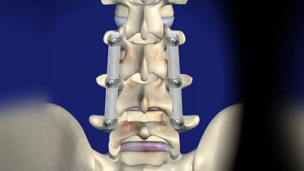 نصائح بعد إجراء عملية تثبيت الفقرات