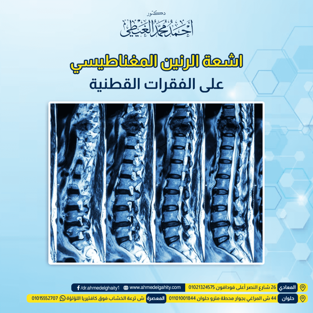 اشعة الرنين المغناطيسي على الفقرات القطنية