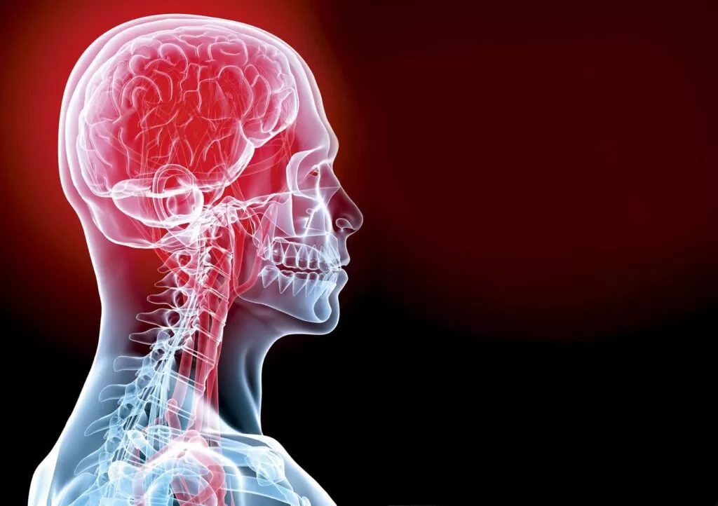 حالات السكتة الدماغية النزفية