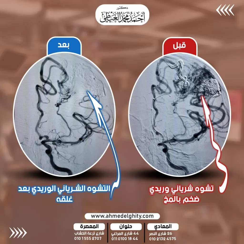 أفضل دكتور قسطرة مخية في مصر, علاج التشوه الشرياني الوريدي المخي بالقسطرة, علاج نزيف المخ بالقسطرة, جلطة المخ ونزيف المخ.