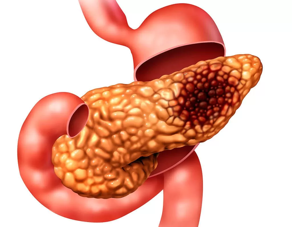 سرطان البنكرياس