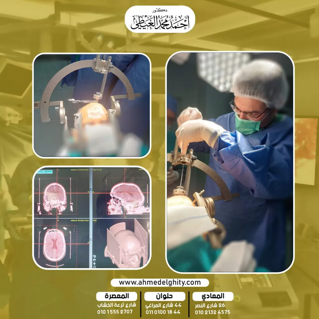 
جراحة الشلل الرعاش
مرض الشلل الرعاش أو مرض باركنسون هو أحد الأمراض العصبية المزمنة التي تصيب المسنين بصورة رئيسية وقد يصيب فئة الشباب في بعض الحالات النادرة.

احجز موعدك مع دكتور أحمد الغيطي
يعد السبب الرئيسي للإصابة بمرض باركنسون هو نقص مادة الدوبامين في الجسم وهي مادة كيميائية توجد في المخ حيث تمتلك دوراً هاماً في الحفاظ على سلاسة الحركات المختلفة للجسم.

أعراض الشلل الرعاش (أعراض الباركنسون)
تبدأ بعض الأعراض المبكرة في الظهور خلال سنوات قبل الاضطرابات الحركية المصاحبة للمرض وتشمل ما يلي:

فقدان حاسة الشم.
تغيرات في الصوت حيث يصبح أكثر ليونة وأحادي النبرة.
صغر حجم خط اليد أثناء الكتابة.
انحناء الظهر.
الاضطرابات الحركية الرئيسية المميزة لمرض باركنسون:
الرعشة والرجفان في الأطراف (الساقين والذراعين) والوجه والفك.
بطء الحركة.
تيبس وتصلب الأطراف (الذراعين والساقين) والجذع.
خلل في التوازن والميل إلى السقوط.
مشية باركنسون وهي إحدى السمات المميزة للمرض في المراحل المتأخرة حيث يمشي المريض في خطوات قصيرة متقطعة مع صعوبة رفع القدم أثناء السير.
تيبس عضلات الأطراف منطقة الرقبة.
بعض الأعراض الثانوية المصاحبة لمرض باركنسون
التعثر أثناء المشي.
السقوط بشكل متكرر.
الهلوسة.
الخرف
مشاكل في الانتباه والذاكرة.
جمود في تعبيرات الوجه.
ما هي أسباب مرض الشلل الرعاش (أسباب مرض باركنسون)؟
يحدث بسبب موت الخلايا العصبية في منطقة معينة بالمخ تُعرف باسم “العقد القاعدية” فيترتب على ذلك نقص في إنتاج مادة الدوبامين وهي عبارة عن ناقل عصبي مسؤول عن الروابط بين الخلايا العصبية في المخ.

بعض العوامل التي تزيد من فرص الإصابة بمرض الشلل الرعاش (باركنسون):
تقدم العمر.
الالتهابات الفيروسية التي تصيب الجهاز العصبي.
التاريخ العائلي والاستعداد الوراثي.
إصابات الرأس.
تناول بعض الأدوية التي تقلل من إفراز الدوبامين.
التعرض إلى بعض المواد السامة مثل المبيدات الحشرية.
الطرق الجراحية المستخدمة في علاج الشلل الرعاش (علاج مرض باركنسون جراحيا)
يتم اللجوء إلى التدخل الجراحي في حالة عدم الاستجابة إلى الأدوية ويشمل التدخل الجراحي مايلي:

تواصل معنا من خلال الواتس آب
التحفيز العميق للمخ (التحفيز العميق للدماغ) (DBS)
العلاج باستخدام المضخة
كي نواة المهاد
التحفيز العميق للمخ (التحفيز العميق للدماغ) (DBS)
هو الإجراء الجراحي الأكثر شيوعاً والمستخدم في علاج مرض باركنسون وقد أظهر التحفيز العميق للمخ بعض الفاعلية في تحسين الأعراض المصاحبة لمرض باركنسون.

يستخدم التحفيز العميق للدماغ في علاج بعض الأمراض العصبية الأخرى مثل التصلب المتعدد، والاكتئاب الشديد ، ومرض الزهايمر.

ممَ يتكون جهاز التحفيز العميق للدماغ؟
يتكون الجهاز من 3 أجزاء رئيسية وهي:

مولد النبضات الكهربائية (محفز عصبي) يعمل بالبطارية.
أقطاب كهربائية مزروعة في مراكز حركة محددة في المخ.
أسلاك معزولة تنقل النبضات الكهربائية من المولد إلى الأقطاب المزروعة في المخ.
كيف يعمل التحفيز العميق للمخ؟
تعتمد فكرة التحفيز العميق للمخ على إجراء تحفيز كهربائي للمخ لضبط مراكز التحكم في حركة الجسم وتحسين الاتصال بين خلايا المخ.

وتشمل خطوات عملية التحفيز العميق للمخ ما يلي:
يتم تثبيت رأس المريض في إطار لمنع الحركة ثم حقن فروة الرأس بمواد مخدرة ويتم حفر ثقوب صغيرة في فروة الرأس، حيث يكون المريض مستيقظ أثناء الجراحة لكي يتمكن من الإجابة على أسئلة الفريق الطبي ويقوم بتحريك مناطق معينة من الجسم حيث يساعد ذلك بجانب التصوير بالأشعة في تحديد مناطق المخ والتي تنشأ فيها أعراض المرض لكي يتم زرع الأقطاب الكهربائية في هذه المناطق.
يمكن زرع الأقطاب الكهربائية في جانب واحد من المخ أو في كلا الجانبين بينما يتم زرع جهاز التحفيز العصبي أو المولد تحت الجلد بالقرب من عظمة الترقوة.
يتم توصيل أسلاك رفيعة تحت الجلد من المولد إلى الأقطاب لإيصال النبضات الكهربائية في المخ.
يغلق الجراح الثقوب الصغيرة في الجمجمة عقب الانتهاء من العملية.
يقضي المريض أول 24 ساعة عقب الجراحة في المستشفى لكي يظل تحت مراقبة الفريق الطبي تجنباً لحدوث مضاعفات.
تدوم البطارية الخاصة بجهاز التحفيز العميق للمخ فترة تتراوح بين 3 إلى 5 سنوات ويتم استبدالها بعد ذلك.
النتائج المتوقعة عقب إجراء جراحة التحفيز العميق للدماغ
عقب مرور أسابيع قليلة من العملية الجراحية يقوم أحد المتخصصين ببرمجة الإعدادات الخاصة بالتحفيز العميق للمخ وفقاً للأعراض.
يحدث تحسن كبير في الأعراض المصاحبة للمرض.
يستطيع المريض أن يقلل من الأدوية التي يتناولها تحت إشراف الطبيب المعالج.
بعض الإرشادات الهامة الخاصة بجهاز التحفيز العميق للمخ
من الضروري أن يحمل المريض بطاقة هوية يذكر فيها اسم الجهاز ونوعه.
عند السفر بالطيران يجب تقديم الهوية للأشخاص المسؤولين عن فحص الركاب قبل ركوب الطائرة و إبلاغهم بوجود جهاز تحفيز عصبي حتى لا تتأثر برمجة الجهاز بأجهزة تفتيش المطار.
تجنب إجراء التصوير بأشعة الرنين المغناطيسي أو استخدام الحرارة في العلاج الطبيعي.
يجب مراجعة الطبيب عند التعرض إلى صدمة في منطقة الصدر بالقرب من الجهاز.
ابتعد عن الآلات ذات الجهد العالي وأفران الصهر ومولدات الطاقة.
يمكنك استخدام التليفون المحمول والأجهزة المنزلية وأجهزة الكمبيوتر لأنها لا تتداخل مع عمل الجهاز.
العلاج باستخدام مضخةالدوبامين
مضخة الدوبامين هي إحدى الطرق العلاجية الحديثة التي تمت الموافقة عليها من جانب إدارة الغذاء والدواء الأمريكية (FDA) في يناير 2015.

تعتمد فكرة المضخة على إيصال الدواء المعالج لمرض باركنسون في شكل مادة هلامية أو جيلاتينية تدخل مباشرة إلى الأمعاء الدقيقة مما يساعد على تقليل عدد الأقراص الدوائية التي يتناولها مريض الشلل الرعاش بالإضافة إلى تخفيف حدة الأعراض.

كيف يتم زرع المضخة في جسم المريض؟
يجري الطبيب عملية جراحية بسيطة يتم خلالها زرع أنبوب رفيع في جزء من الأمعاء الدقيقة بالقرب من المعدة ويتصل هذا الأنبوب بجهاز صغير في خارج الجسم يحتوي على المضخة ومجموعة من شرائط الجيل أو المادة الهلامية.

يوفر كل شريط واحد فقط من المادة الهلامية نحو 16 ساعة من العلاج اللازم على مدار اليوم ويتم تغيير الشريط مرة أو مرتين في اليوم على حسب حالة المريض.

تتم برمجة المضخة رقمياً لكي تُخرج الدواء بالجرعات الصحيحة مع ضرورة مراقبة الأنبوب المتصل بالمضخة بصورة دقيقة.

هل العلاج بمضخة الدوبامين أثبت فاعليته؟
يوفر العلاج الذي يتم توصيله بالمضخة فاعلية أكبر في تخفيف الأعراض المصاحبة للمرض على عكس أقراص الدواء التي تستغرق فترة زمنية أطول لكي يمتصها الجسم.

من أهم التركيبات الدوائية الفعالة المستخدمة في علاج مرض باركنسون عبر المضخة هي خليط مكون من دوائي ليفودوبا و كاربيدوبا.

من هي الفئات المستهدفة في العلاج بمضخة الدوبامين؟
كشفت بعض الدراسات عن أن العلاج باستخدام المضخة أظهر فاعلية كبيرة لدى مرضى المراحل المتأخرة لمرض الشلل الرعاش الذين لم تعد حبوب الدواء تمتلك أي تأثير فعال لديهم، ويرجع ذلك إلى التأثير السلبي لمرض باركنسون على عملية الهضم في جسم المريض وبطء امتصاص الدواء وبالتالي تقل فاعليته وتأثيره على المرض.

بعض المخاطر المحتملة لمضخة الدوبامين:
الإصابة بعدوى ميكروبية في الأنبوب المتصل بالأمعاء الدقيقة.
حدوث انسداد في الأنبوب.
سقوط الأنبوب.
تسرب الأنبوب.
من الجدير بالذكر أن العلاج باستخدام مضخة الدوبامين قد لا يكون حلاً مثالياً لجميع مرضى الشلل الرعاش لأنه علاج جديد نسبياً.

كي نواة المهاد
تهدف العملية إلى السيطرة على الرعشة والحركات اللاإرادية التي يسببها المرض.

يتم تدمير النواة المتوسطة في المهاد وهي المسؤولة عن التحكم في بعض الحركات اللاإرادية في جسم الإنسان.

قبل التدخل الجراحي يخضع المريض إلى إجراء بعض الفحوصات التفصيلية للمخ مثل التصوير بالأشعة المقطعية أو الرنين المغناطيسي لتوفير صورة ثلاثية الأبعاد للمخ للتأكد من الموقع الدقيق لمنطقة نواة المهاد في المخ.

يتم إجراء التدخل الجراحي تحت تأثير المخدر الموضعي يتم تخدير فروة الرأس، ثم يصنع الطبيب فتح صغير في الجمجمة باستخدام الأدوات الدقيقة يتمكن الطبيب من الوصول إلى نواة المهاد.

يقوم دكتور أحمد الغيطي بتعريض المنطقة المستهدفة إلى تيار كهربائي ليتم كيها.

دكتور أحمد الغيطي

استشاري جراحة المخ والأعصاب والعمود الفقري والقسطرة المخية التداخلية.
استشاري جراحة ألمخ والأعصاب الوظيفية وجراحة الصرع وجراحة الشلل الرعاش بالاستيريوتاكسي.
دكتوراة جراحة المخ والأعصاب – كلية طب القصر العيني – جامعة القاهرة (MD)
زميل البورد الأوروبي للجراحات العصبية (FEBNS)
الزمالة المصرية لجراحة المخ والأعصاب (FEgBNS)

تابعونا على صفحة الفيسبوك من هنا

للاستفسارات والحجز

عيادة المعادي: 26 شارع النصر أعلى فودافون ت/ 01021324575
وعيادة حلوان: 44 شارع المراغي بجوار محطة مترو حلوان ت: 01101001844
عيادة المعصرة: ش ترعة الخشاب فوق كافيتيريا اللؤلؤة ت/ 01015552707