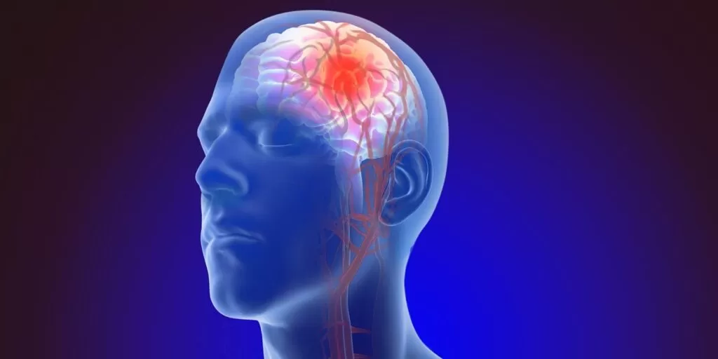 أعراض النزيف بالمخ