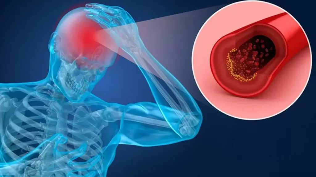 أعراض جلطة جذع المخ