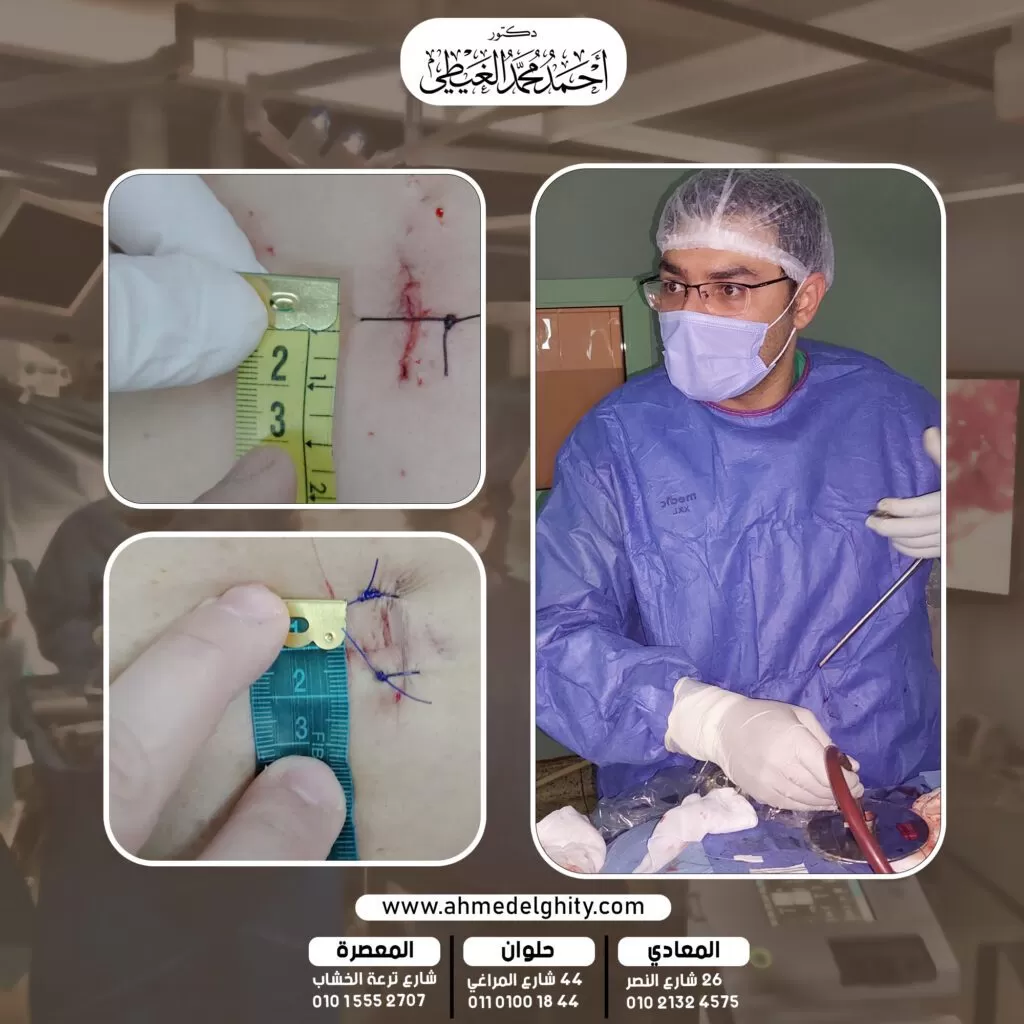 نقاهة ما بعد استئصال الانزلاق الغضروفي بالمنظار