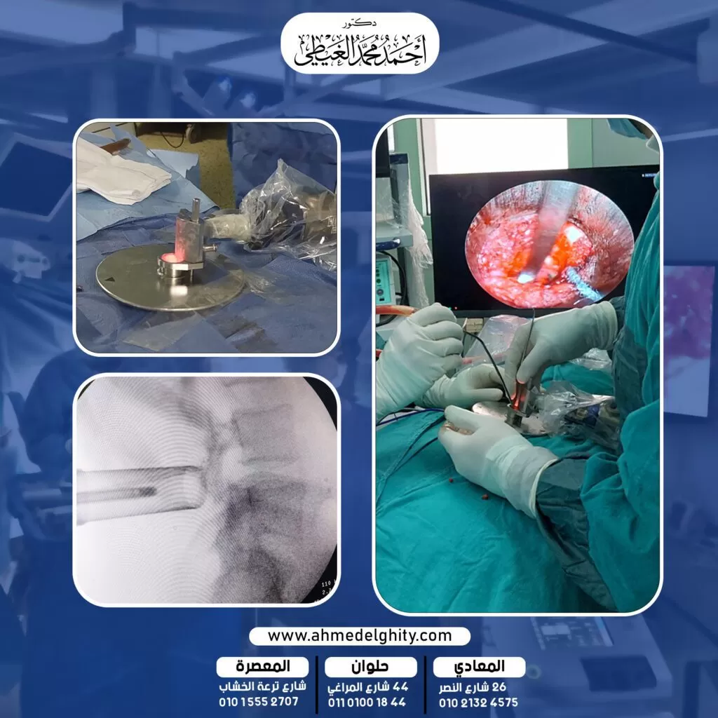 ما هو منظار العمود الفقري؟