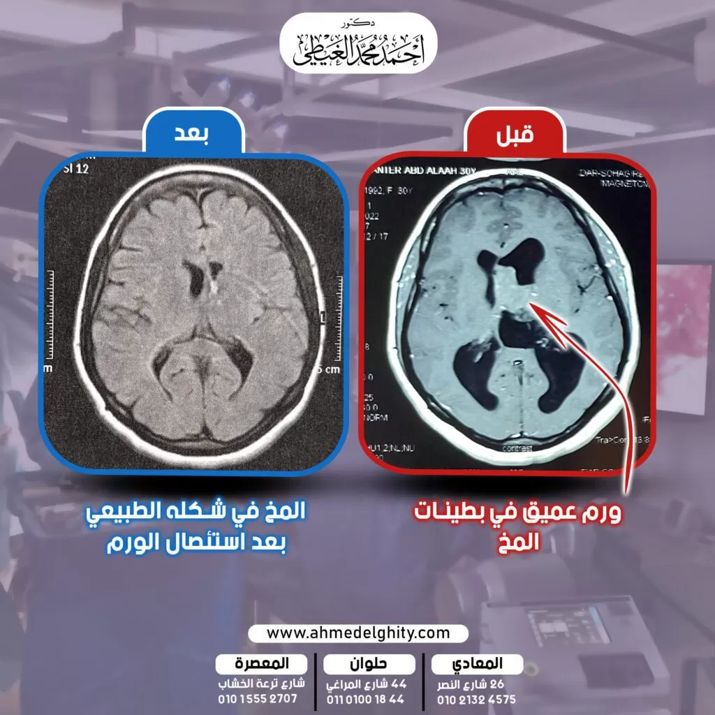 متى يقرر الدكتور استئصال ورم المخ الخبيث جراحياً؟