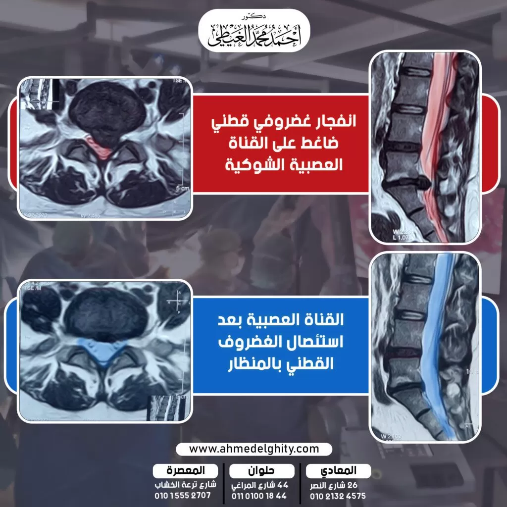 فوائد جراحة استئصال الانزلاق الغضروفي بالمنظار