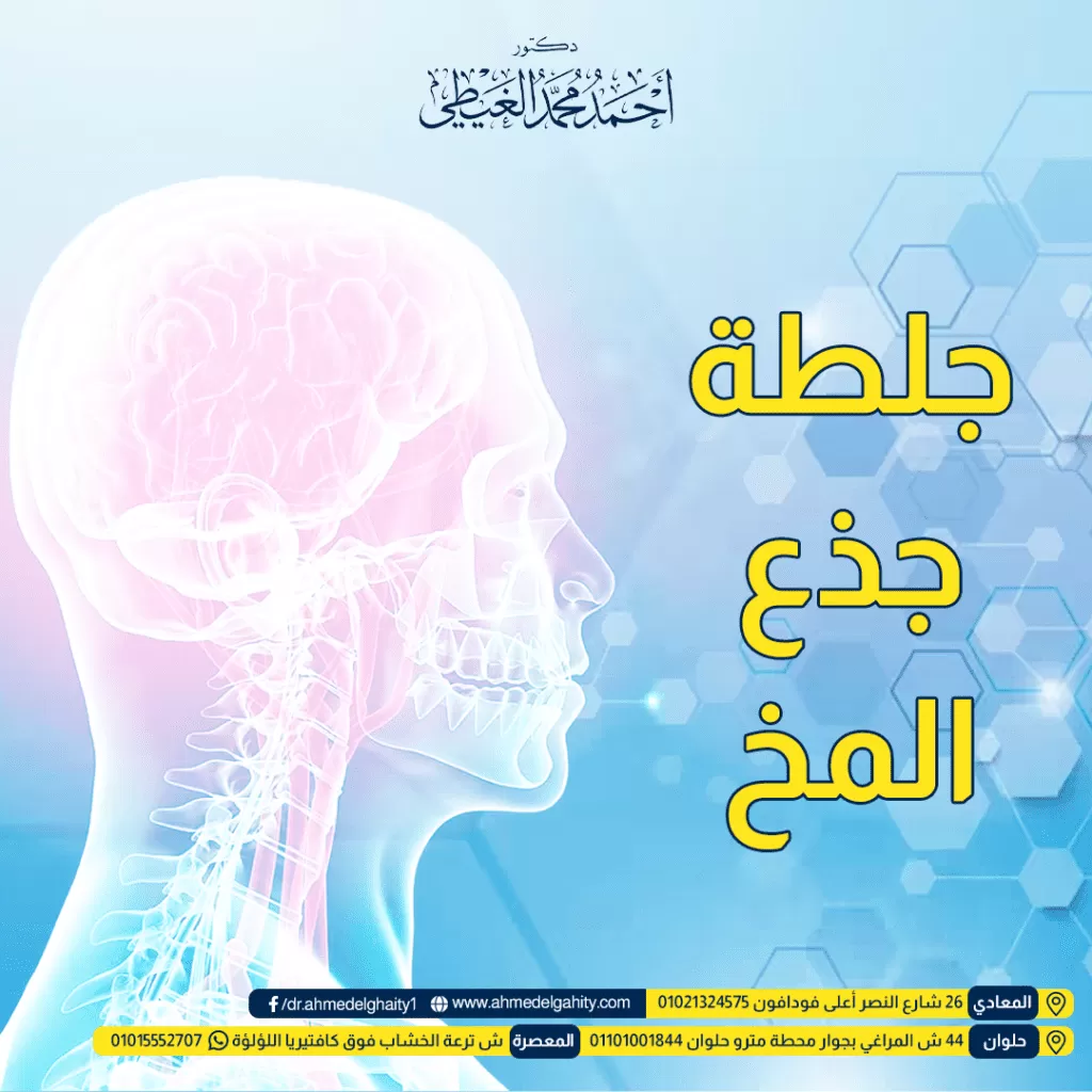 جلطة جذع المخ