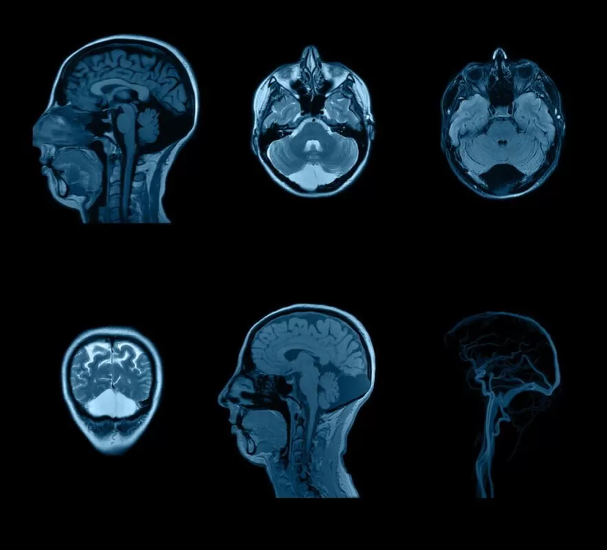 طرق علاج تسرب السائل المخي