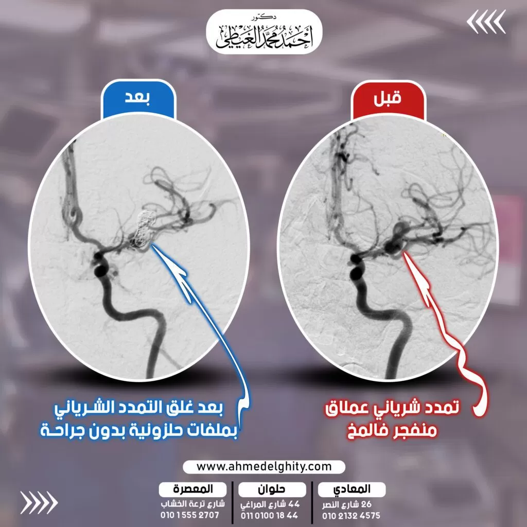 غلق تمدد شرياني عملاق بالمخ اكتشف قصة نجاح إحدى عمليات القسطرة المخية التداخلية لغلق أحد أصعب وأعقد أنواع التمددات الشريانية المخية المنفجرة في المخ على الإطلاق، واللي كانت من أسباب شفاء المريض الذي كان تعاني من تمدد شرياني عملاق منفجر في المخ. الحالة المرضية: رجل يبلغ من العمر أربعون عاما. شعرالمريض بصداع حاد جدا ومفاجئ تبعه تدهور في درجة الوعي. وعند التوجه للمستشفى وعمل الفحوصات المطلوبة تبين وجود نزيف تلقائي حاد تحت الأم العنكبوتية في المخ. تم بسرعة عمل قسطرة تشخيصية على شرايين المخ والرقبة. ليتم اكتشاف وجود تمدد شرياني عملاق بالمخ نازف ومنفجر مصدره الشريان الأوسط بالمخ. وهو أكبر الشرايين المغذية للمخ حيث يقوم بالإمداد الدموي لكل مراكز الإحساس والحركة والكلام. أعراض الإصابة بنزيف في المخ نتيجة انفجار تمدد شرياني نازف. كان المريض يعاني من صداع حاد مفاجئ وضعف في القدرة الحركية وعدم انتظام الكلام. بالإضافة لازدواجية في الرؤية. مضاعفات عدم اجراء غلق تمدد شرياني عملاق بالمخ رغم ما يحمله انفجار التمدد الشرياني من مخاطر كبيرة جدا على الحياة. إلا أن التمدد الشرياني النازف في حالة عدم غلقه قد ينفجر مرة أخرى ويتسبب في نزيف كارثي مرة أخرى بالمخ. وهو ما يحمل نسب عالية جدا من الوفاة والخطورة والتلف البالغ للمخ. إجراء العملية لغلق التمدد الشرياني النازف بدون جراحة قام دكتور أحمد الغيطي استشاري جراحة المخ والأعصاب والقسطرة المخية التداخلية بإجراء تدخل متناهي الدقة بالقسطرة المخية التداخلية لغلق التمدد الشرياني المنفجر وحماية المريض من انفجاره مرة أخرى. وتم ذلك في وحدة القسطرة المخية التداخلية عبر قسطرة مخية ميكروسكوبية متناهية الدقه قام من خلالها بالوصول لقلب التمدد الشراني من داخله. وقام دكتور أحمد الغيطي بغلق التمدد الشرياني من داخله عن طريق ادخال أسلاك حلزونية تمنع الدم من الوصول للتمدد وتحمي جدار التمدد الشرياني من الإنفجار مرة أخرى. نتيجة عملية غلق تمدد شرياني عملاق بالمخ بالقسطرة المخية التداخلية خروج المريض بوعي وقوة حركية كاملة، وممارسة حياته اليومية بشكل طبيعي وآمن بعد الجراحة. أفضل دكتور لعلاج نزيف الناتج عن تمدد شرياني بالمخ أفضل وأحسن دكتور مخ وأعصاب يقوم نزيف المخ الناتج عن انفجار تمدد شرياني بالمخ هو جراح المخ والأعصاب الذي تدرب على فروع جراحات المخ والأعصاب متناهية الدقة والميكروسكوبية. سواء باستخدام الميكروسكوب الجراحي أو باستخدام منظار المخ أو باستخدام القسطرة المخية التداخلية. كما يجب أن يكون متمكنا من دراسة التاريخ المرضي للحالة بدقة والتأكد من سبب النزيف المخي الموجود لدى المريض. ويقوم دكتور أحمد الغيطي باجراء كافة طرق علاج نزيف المخ بسبب انفجار التمددات الشريانية المخية سواء جراحيا أو عن طريق القسطرة المخية التداخلية. أفضل دكتور مخ وأعصاب لعلاج أورم المخ عند الأطفال عيادة دكتور أحمد الغيطي استشاري جراحة المخ والأعصاب والعمود الفقري اقرأ أيضا: (مصادر) جراحات الأوعية الدموية المخية والقسطرة المخية التداخلية توسيع الشريان السباتي جراحيا مرض ضيق الشريان السباتي علاج يذيب جلطة المخ علاج جلطة المخ بالقسطرة ما هي أسباب جلطة المخ (أسباب السكتة الدماغية)؟ تكلفة عملية قسطرة المخ في مصر مراجع داخلية: اعراض ورم المخ وعلاجه فى عيادات دكتور أحمد الغيطي نحرص على اتباع الخطوات اللازمة للتعرف على حالتك وبناء خطة علاجية فعالة. اضغط هنا لحجز موعد في عيادة دكتور أحمد الغيطي لعلاج جلطة المخ بسبب ضيق الشريان السباتي دكتور أحمد الغيطي استشاري جراحة المخ والأعصاب والعمود الفقري والقسطرة المخية التداخلية. استشاري جراحة ألمخ والأعصاب الوظيفية وجراحة الصرع وجراحة الشلل الرعاش بالاستيريوتاكسي. دكتوراة جراحة المخ والأعصاب – كلية طب القصر العيني – جامعة القاهرة (MD) زميل البورد الأوروبي للجراحات العصبية (FEBNS) الزمالة المصرية لجراحة المخ والأعصاب (FEgBNS) تابعونا على صفحة الفيسبوك من هنا للاستفسارات والحجز عيادة المعادي: 26 شارع النصر أعلى فودافون ت/ 01021324575 وعيادة حلوان: 44 شارع المراغي بجوار محطة مترو حلوان ت: 01101001844 عيادة المعصرة: ش ترعة الخشاب فوق كافيتيريا اللؤلؤة ت/ 01015552707 احجز موعدك مع دكتور أحمد الغيطي شارك المقال مع أصدقائك