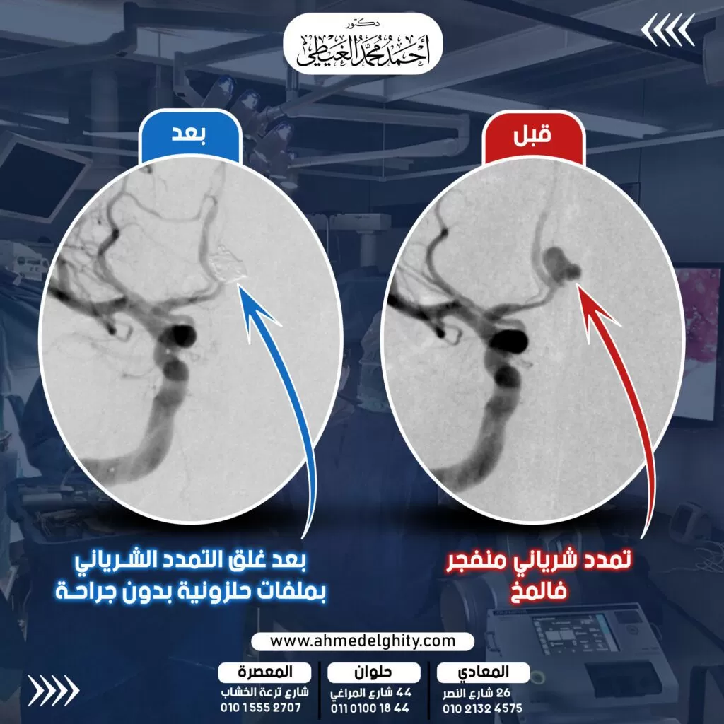 تدخل عاجل بالقسطرة المخية ينقذ حياة شاب مصاب بنزيف بالمخ نزيف المخ احد الأمراض شديدة الصعوبة في العلاج. نظرا لما يحدثه النزيف من تلف في النسيج المخي, بالإضافة لخطورة ارتجاع النزيف مرة اخرى في حالة عدم معرفة سببه ووقفه. وهو ما ينصح به دائما دكتور أحمد الغيطي استشاري جراحة المخ والاعصاب والقسطرة المخية التداخلية. من أنواع نزيف المخ النزيف التلقائي الحاد تحت الأم العنكبوتية. ويحدث ذلك النوع غالبا بسبب انفجار تمدد شرياني أو تشوه شرياني وريدي بالمخ. ويعتبر أخطر أنواع النزيف المخي على الإطلاء وأعلاها في نسب الوفاة. وفيما يلي حالة مرضية قام دكتور احمد الغيطي باستقبالها وعلاجها وانقاذ حياتها لشاب في مقتبل العمر. الحالة المرضية للمريض المصاب بنزيف المخ: شاب يعمل سائق. شعر بصداع حاد ومفاجئ تبعه تدهور بدرجة الوعي. توجه المريض لإحدى المستشفيات وبعمل أشعة مقطعية تبين وجود نزيف حاد تلقائي بالمخ تحت الأم العنكبوتية. وتم ابلاغ طوارئ وزارة الصحة والتي قامت بدورها بالتنسيق مع دكتور أحمد الغيطي لاستقبال الحالة في مستشفى 15 مايو نظرا لامتلاك المستشفى وحدة قسطرة مخية متكاملة تحت اشراف دكتور أحمد الغيطي استشاري جراحة المخ والاعصاب والقسطرة المخية التداخلية. أعراض الإصابة بانفجار تمدد شرياني في المخ: صداع حاد, تدهور بدرجة الوعي, تدهور بالرؤية والحركة. عمل قسطرة تشخيصية على المخ. فور وصول الحالة للمستشفى قام دكتور أحمد الغيطي استشاري جراحة المخ والأعصاب والقسطرة المخية التداخلية بعمل قسطرة تشخيصية على شرايين المخ ليتبين وجود تمدد شرياني منفجر ونازف في الشريان الامامي للمخ. ويحمل درجة عالية جدا من خطورة ارتجاع النزيف مرة أخرى. وهو ما يهدد حياة المريض بشكل بالغ. خطورة عدم علاج التمدد الشرياني المنفجر أو التأخر في غلقه: نزيف متكرر بالمخ, يحمل نسبة وفاة تتعدى ال 90% اجراء القسطرة المخية العلاجية لغلق التمدد الشرياني قام دكتور احمد الغيطي استشاري جراحة المخ والأعصاب والقسطرة المخية والفريق المساعد له بعمل قسطرة علاجية عاجلة للمريض فجرا. ليتم غلق التمدد الشرياني ومنع نزفه او انفجاره مرة أخرى. وذلك في عملية استغرقت ثلاثة ساعات في وحدة القسطرة المخية التداخلية بالمستشفى. وتم غلق التمدد الشرياني النازف باسلاك حلزونية متناهية الدقة. لمنع وصول الدم للتمدد الشرياني وحماية المريض من انفجاره مرة أخرى. نتيجة غلق التمدد الشرياني النازف في المخ بأسلاك حلزونية: خرج المريض بوعي كامل وقوة حركية كاملة، محتفظا بالقدرة على المشي والحركة وخالي من المضاعفات. وآمن من عودة نزيف المخ مرة أخرى. أفضل دكتور لعلاج التمدد الشرياني المخي أفضل وأحسن دكتور مخ وأعصاب يقوم بعلاج تمدد شرايين المخ هو جراح المخ والأعصاب الذي تدرب على فروع جراحات المخ والأعصاب متناهية الدقة والميكروسكوبية. سواء باستخدام الميكروسكوب الجراحي أو باستخدام منظار المخ أو باستخدام القسطرة المخية التداخلية. كما يجب أن يكون متمكنا من دراسة التاريخ المرضي للحالة بدقة والتأكد من سبب نزيف المخ الموجود لدى المريض. ويقوم دكتور أحمد الغيطي باجراء كافة طرق علاج نزيف المخ بسبب انفجار التمددات الشريانية المخية سواء جراحيا أو عن طريق القسطرة المخية التداخلية.