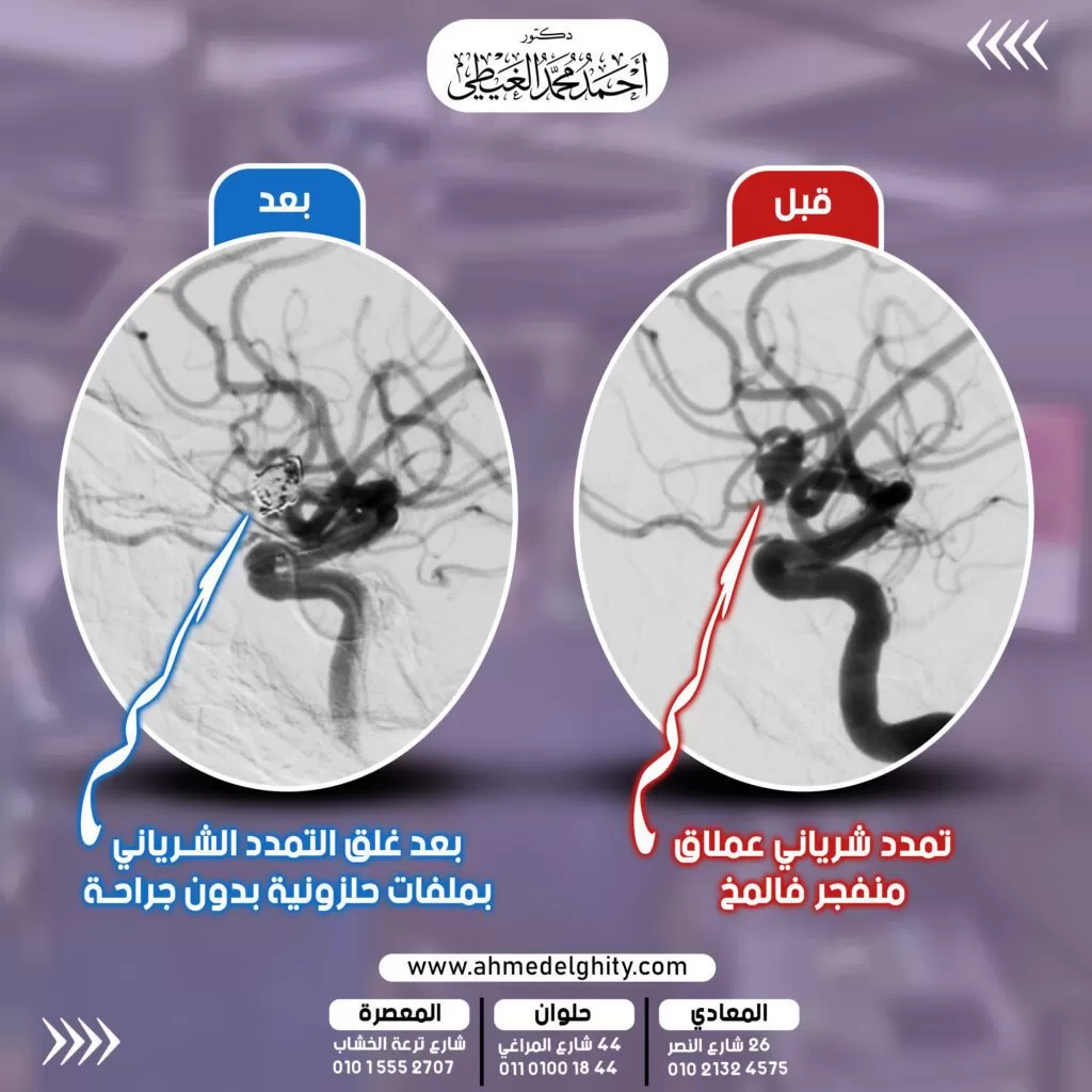 غلق تمدد شرياني نازف بالمخ