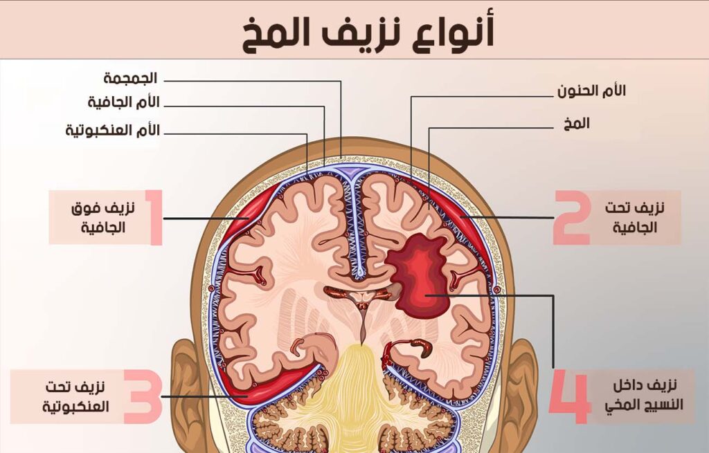 أنواع نزيف المخ