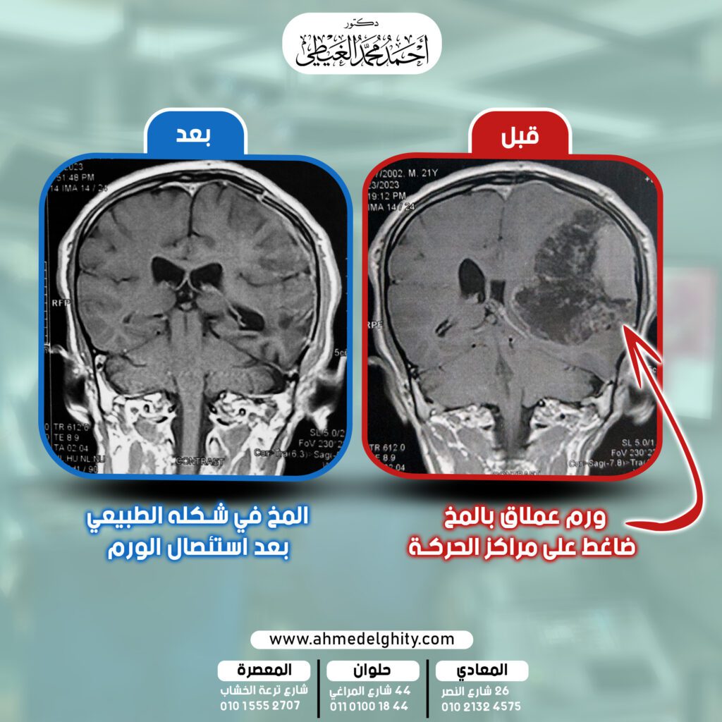 ورم المخ, سرطان المخ, ورم ضخم في المخ, سرطان الدماغ, دكترو مخ واعصاب, أفضل دكتور مخ وأعصاب, دكتور لعلاج ورم المخ