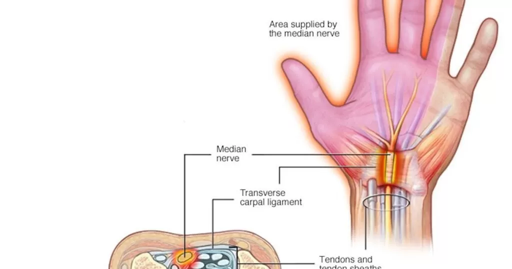 أسباب قطع عصب اليد