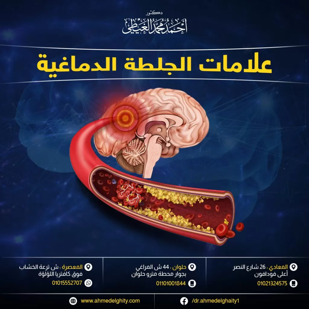 علامات الجلطة الدماغية