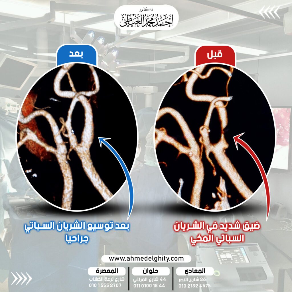 الصورة قبل الجراحة لحالة كانت تعاني من ضيق شديد في الشريان السباتي تسبب بجلطات متعددة متكررة بالمخ. وقام دكتور أحمد الغيطي استشاري جراحة المخ والأعصاب بجراحة ميكروسكوبية لاستئصال بطانة الشريان السباتي وتوسيع الضيق الموجود في الشريان السباتي. مما أدى لمنع تكون جلطات مخية جديدة لدى الحالة ووقاية المريض من مضاعفات الشلل النصفي.