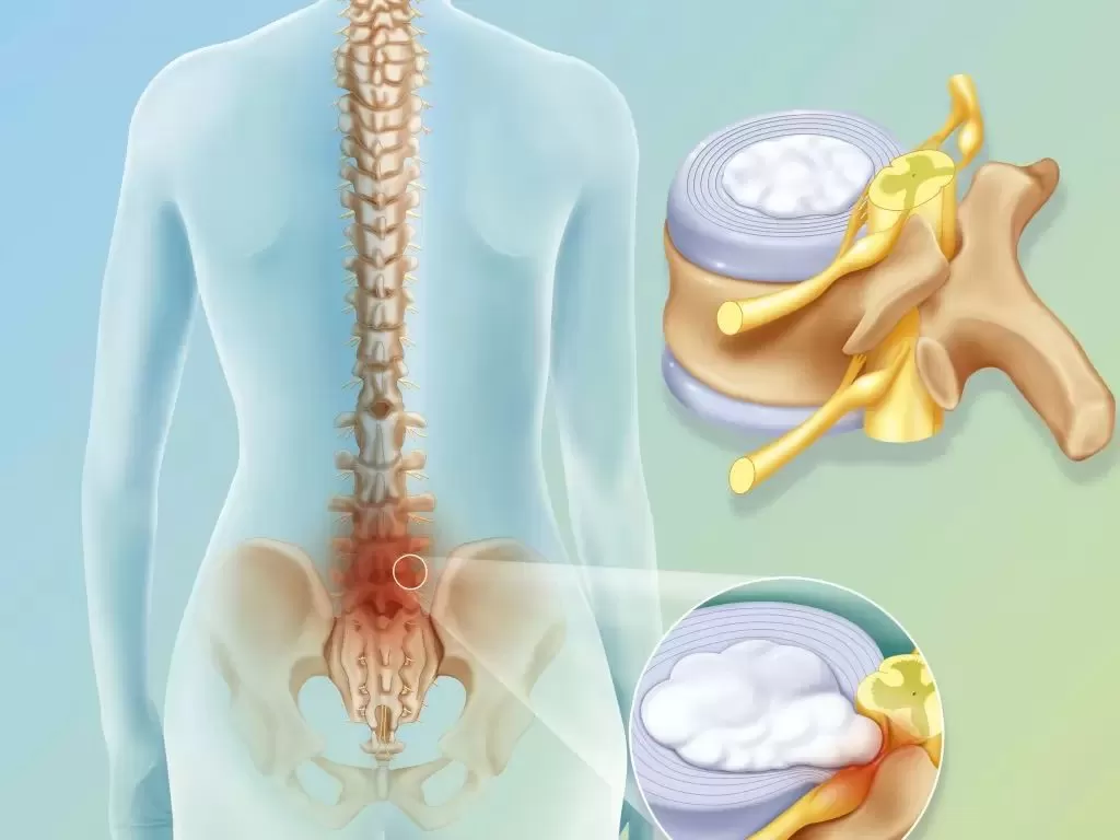 أبرز علامات الشفاء من الانزلاق الغضروفي