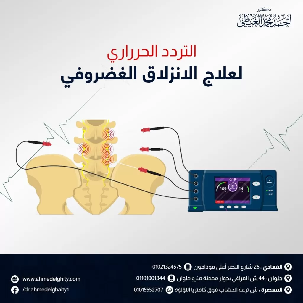 التردد الحراري لعلاج الانزلاق الغضروفي