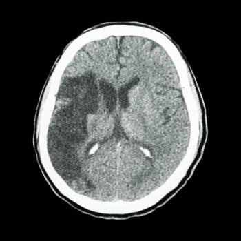 شكل جلطة المخ الإفقارية(Ischemic Stroke) في الأشعة المقطعية