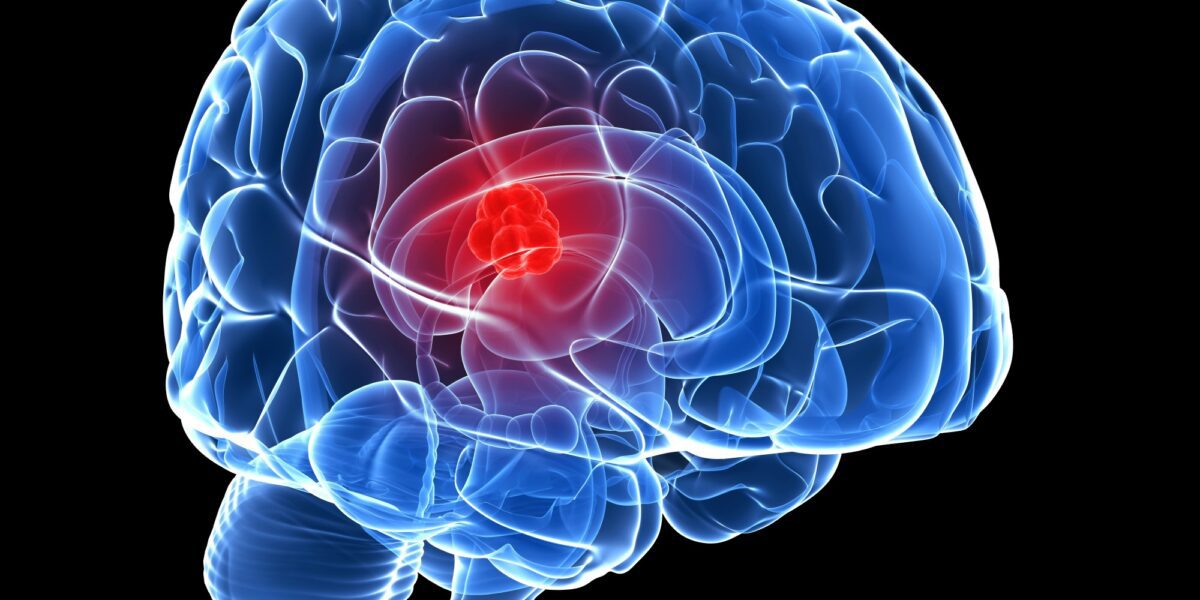 أسباب الإصابة بورم حميد في الدماغ