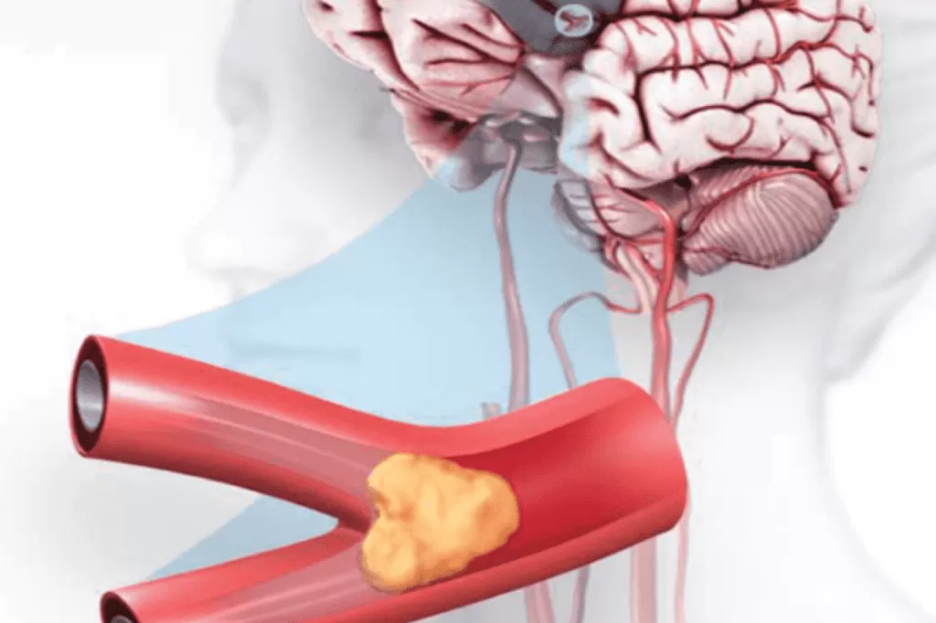 أسباب الجلطة الدماغية الصغرى