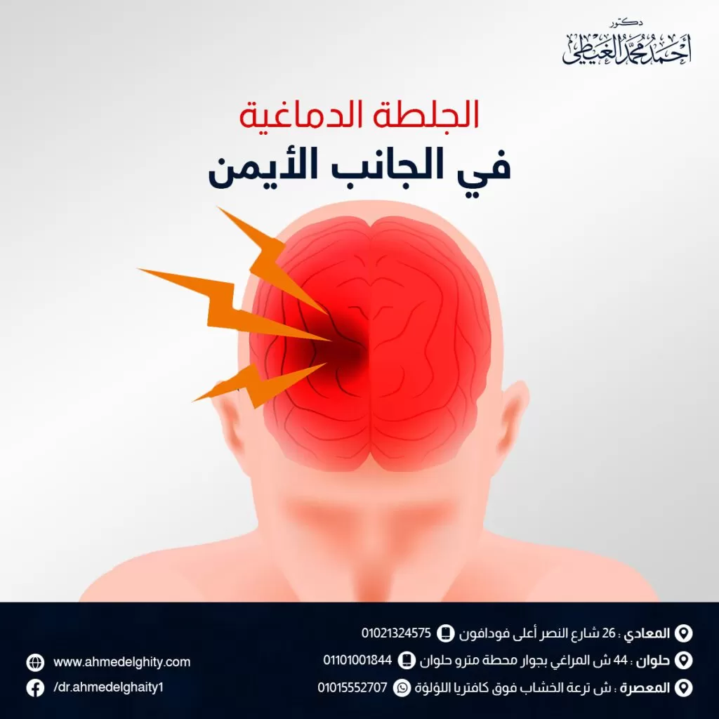 الجلطة الدماغية في الجانب الأيمن