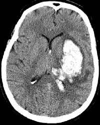 شكل جلطة المخ النزفية (Hemorrhagic Stroke) في الأشعة المقطعية: