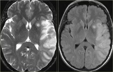 شكل جلطة المخ في الرنين المغناطيسي