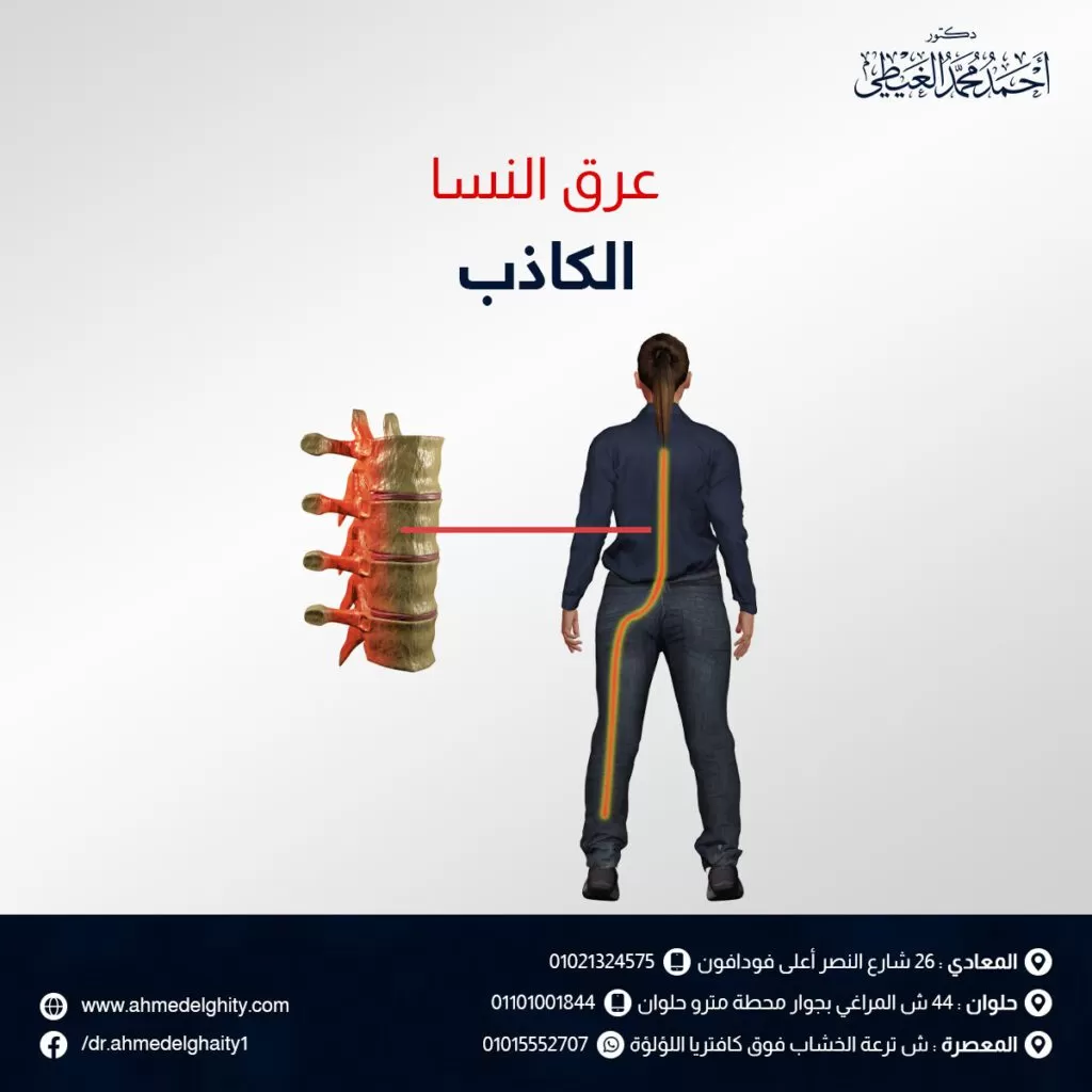 عرق النسا الكاذب