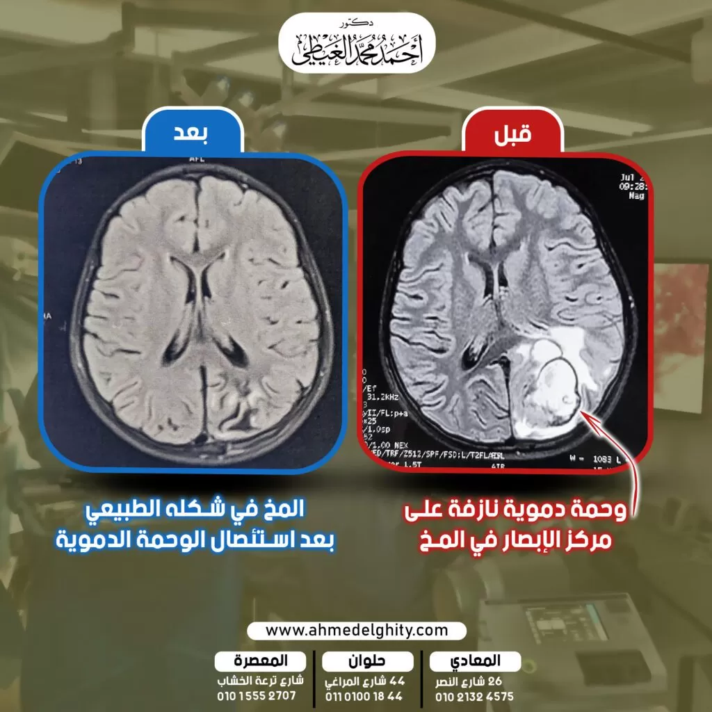 قصة نجاح انقاذ الرؤية عند طفلة تبلغ من العمر 11 عام