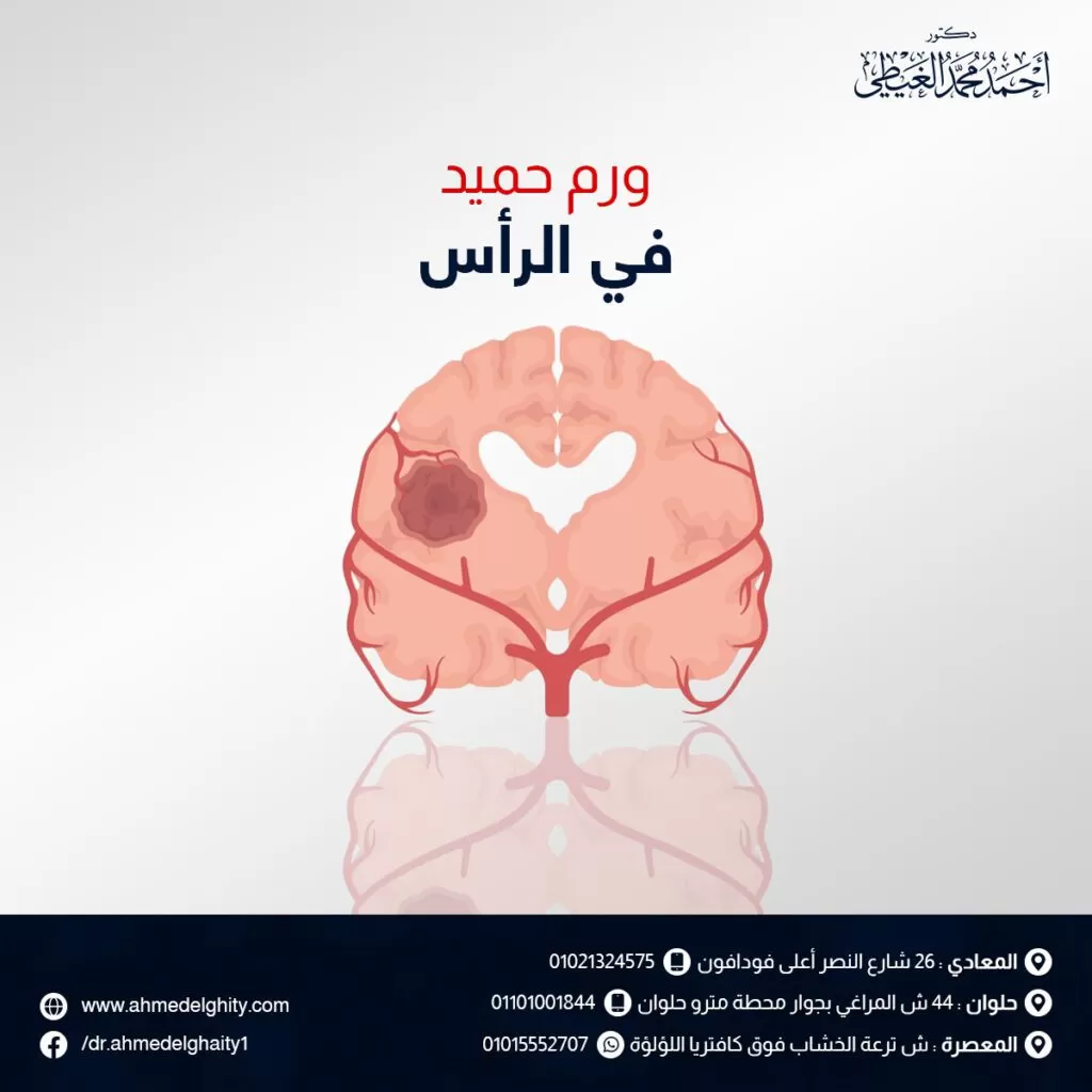 ورم حميد في الرأس