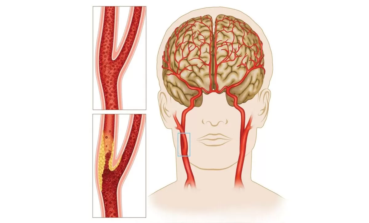 إحصائيات حول نجاح عملية الشريان السباتي