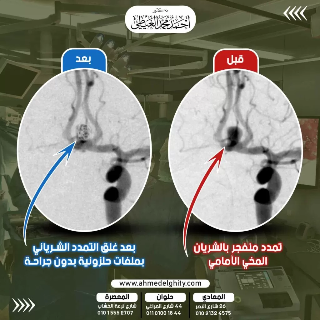 انقاذ حياة سيدة تعاني من انفجار تمدد شرياني بالمخ